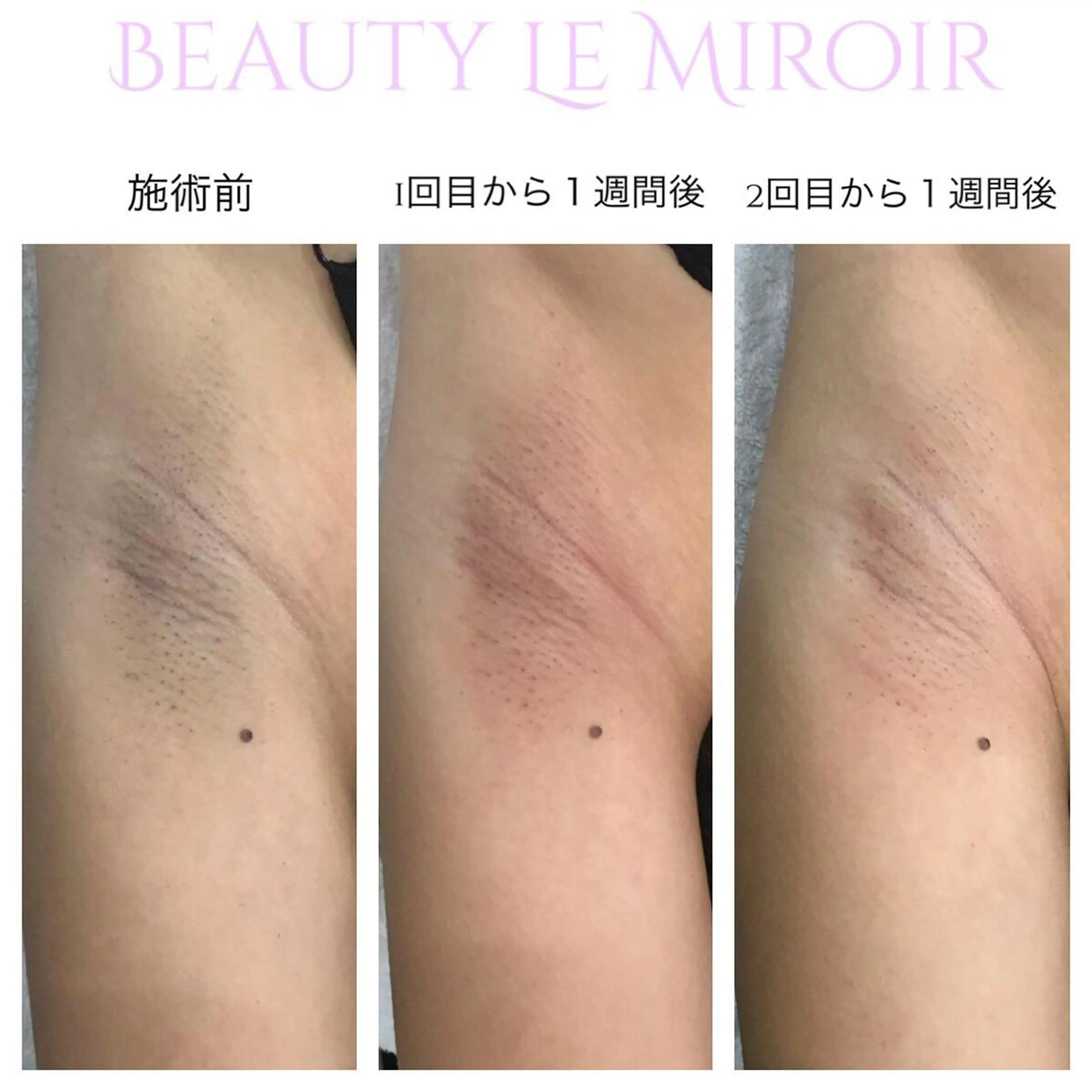 脱毛 ビューティー ミロワールのエステ・リラクイメージ