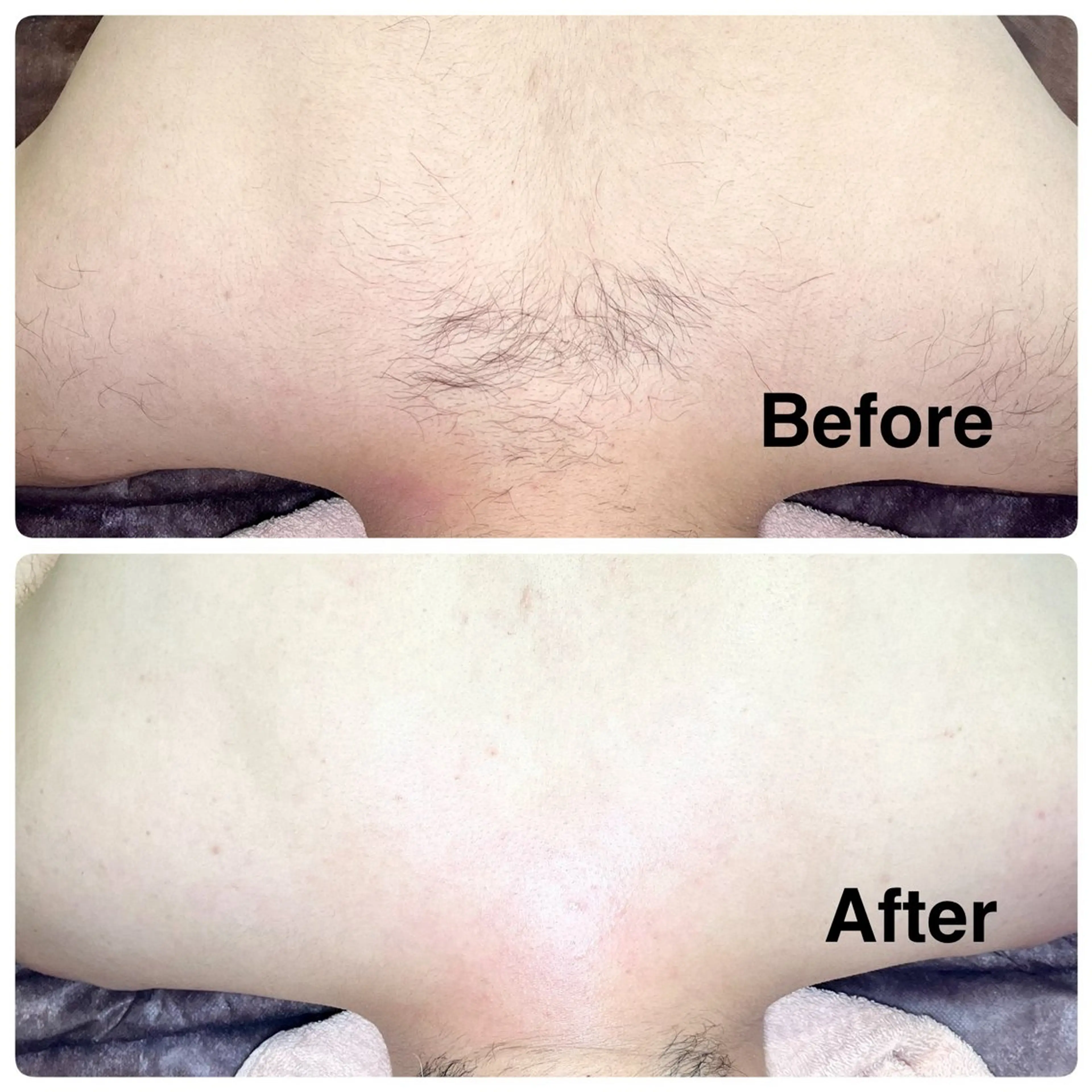 【背中上部ミックス脱毛】産毛やザラつきを整えなめらかな背中に✨【シュガーリング×光脱毛】の写真