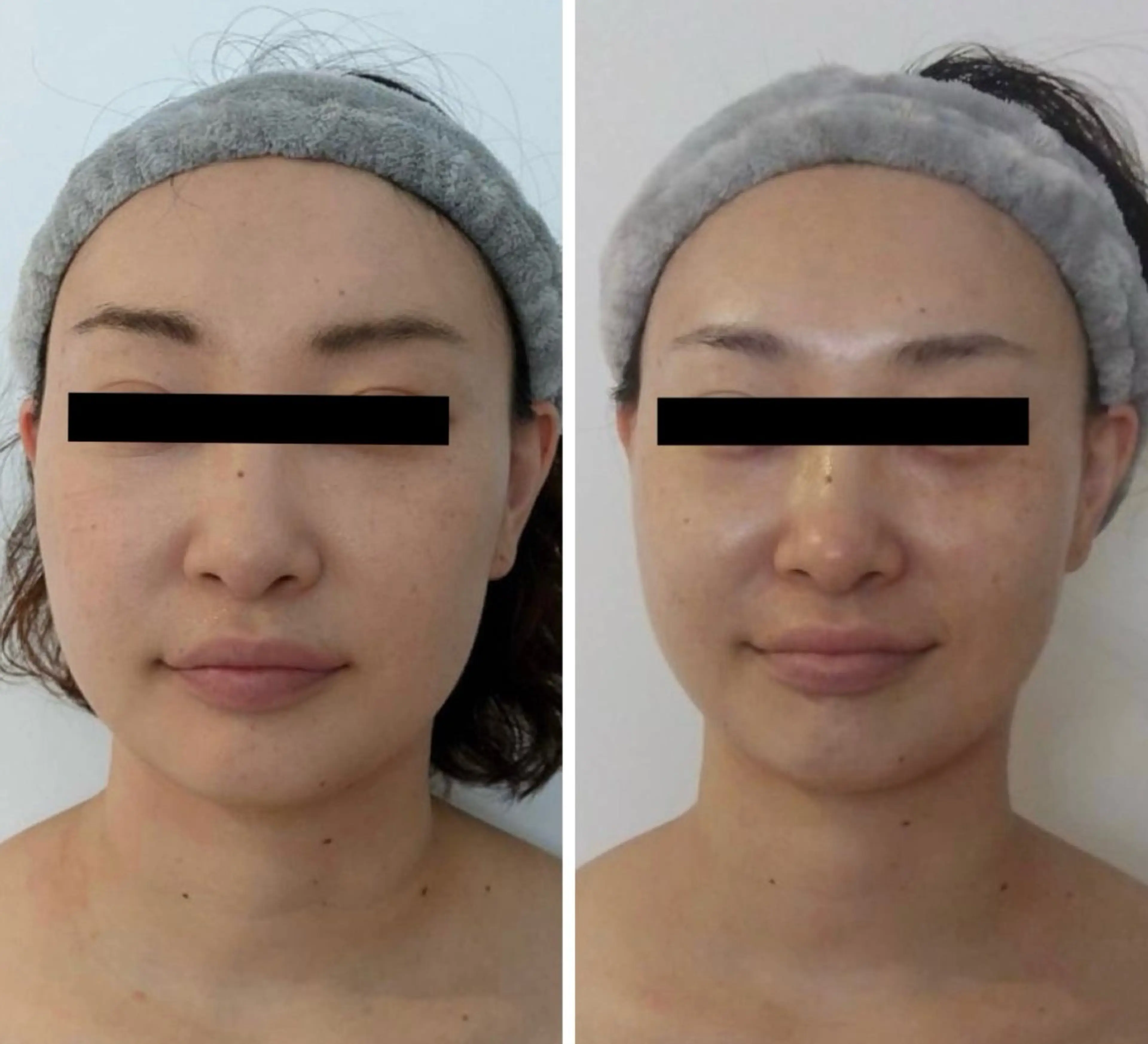 水光韓国肌ハーブ ピーリングMplusのエステ・リラクイメージ