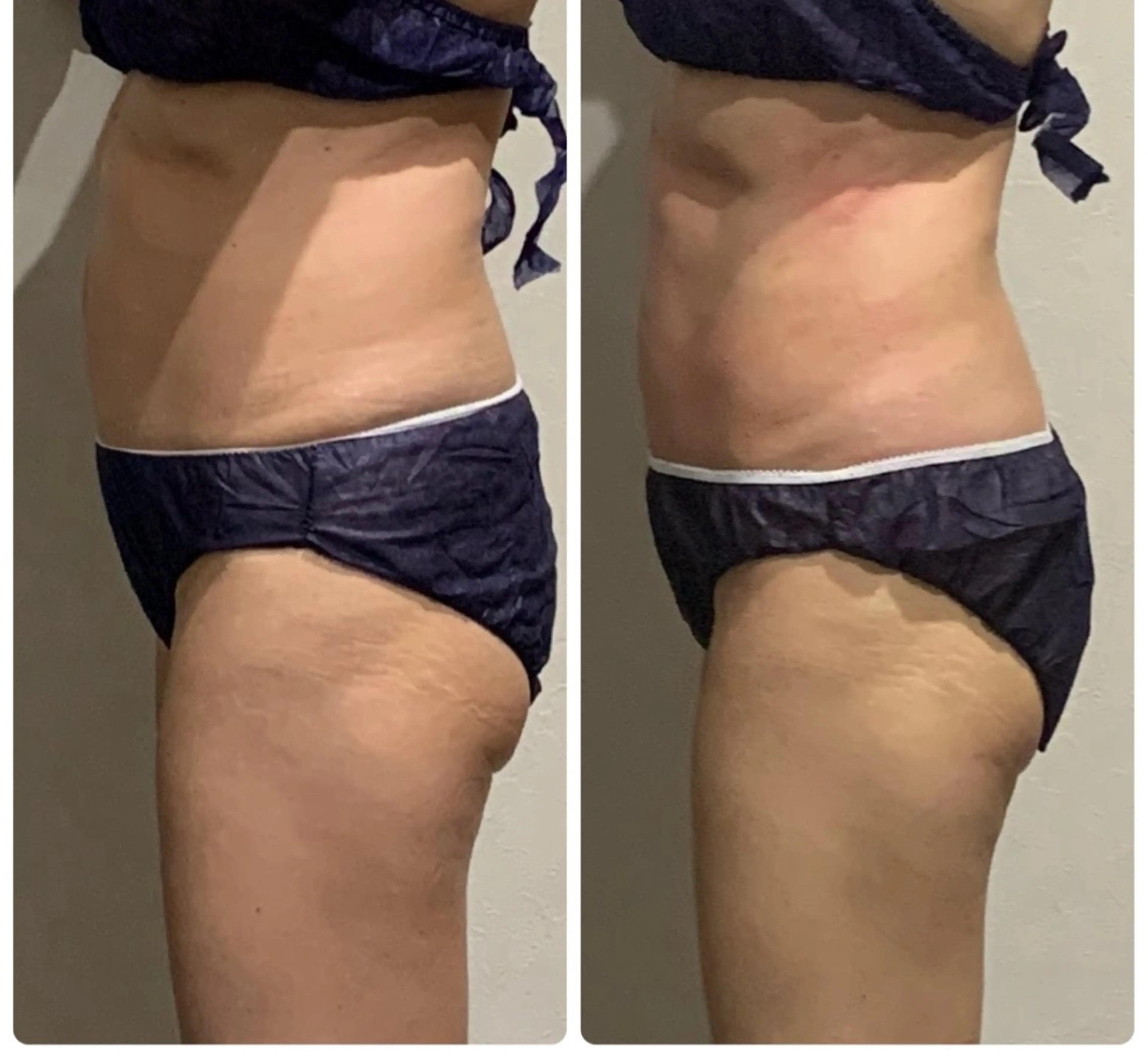 ☆選べる痩身☆＋悩み別耳つぼジュエリー付きの写真