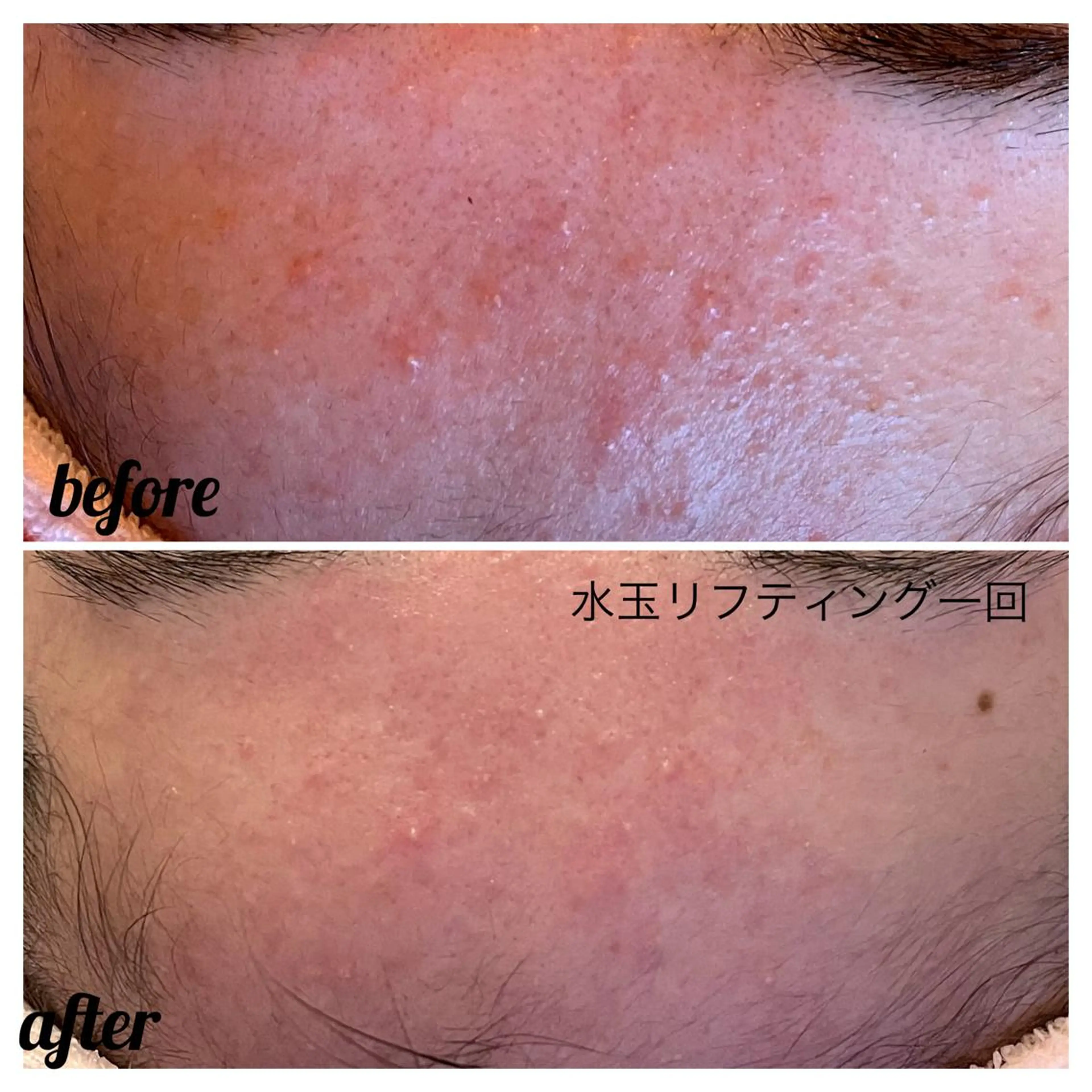 【ニキビ/肌管理】 salon varyのエステ・リラクイメージ