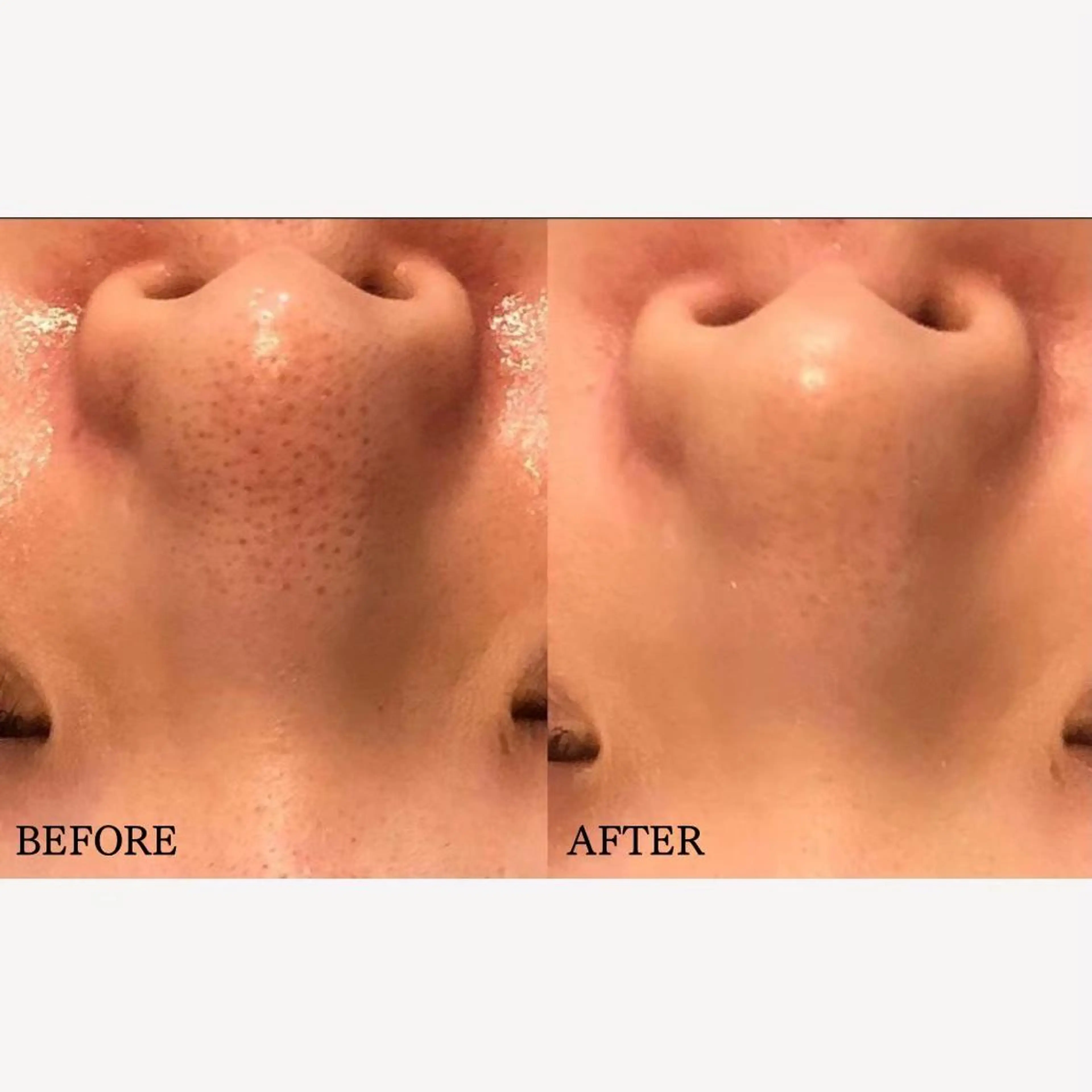 【2段階毛穴洗浄/肌診断付】幹細胞導入付きアクアポア毛穴洗浄¥12300→¥4400の写真