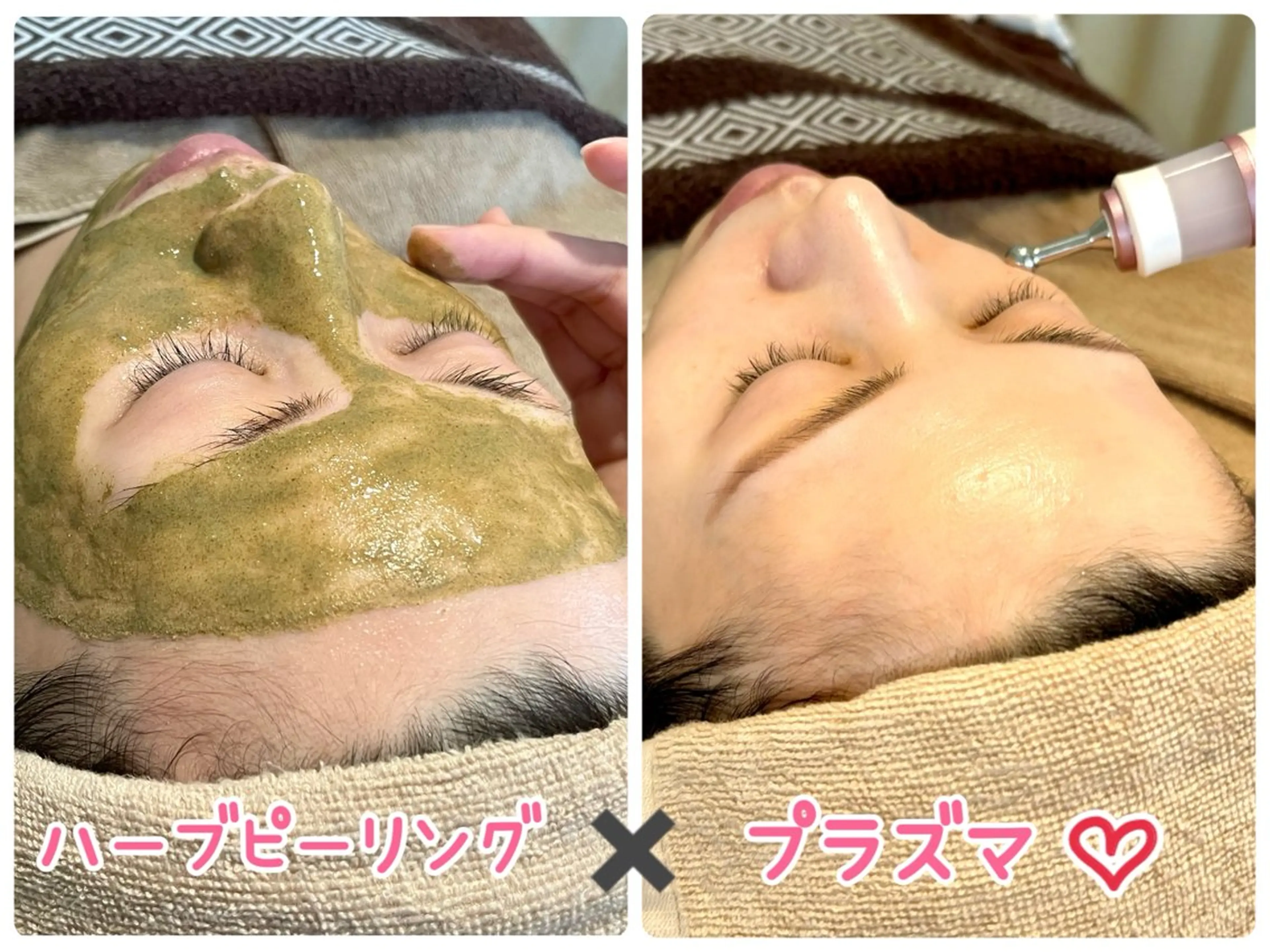 【ミニモセール中✨ハーブとプラズマの力で肌改善💖】ハーブピーリング🌿剥離なし💖ヒト幹細胞プラズマでノンストレス肌にの写真