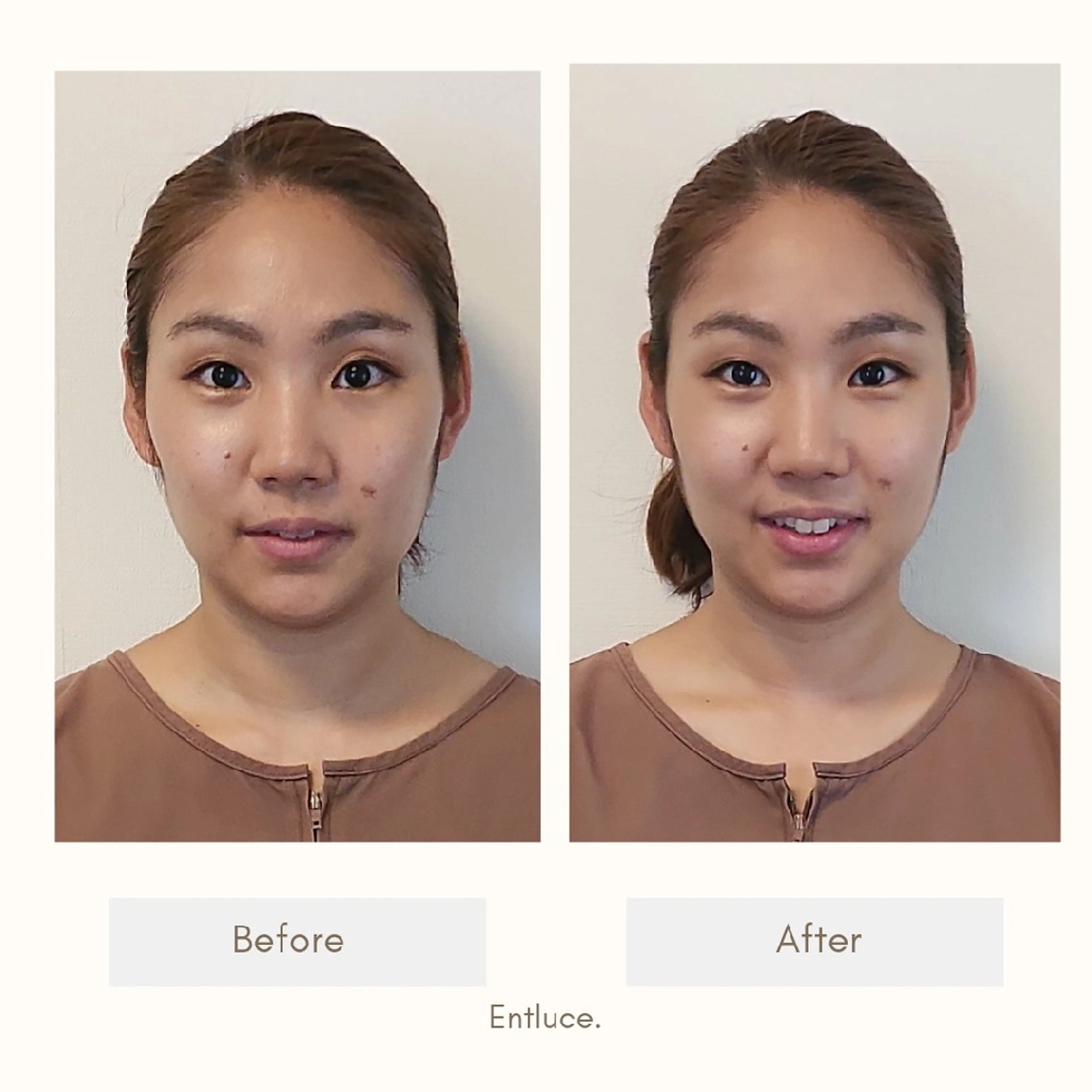 即効⚡小顔美容鍼🪡 むくみたるみ脂肪解消のエステ・リラクイメージ