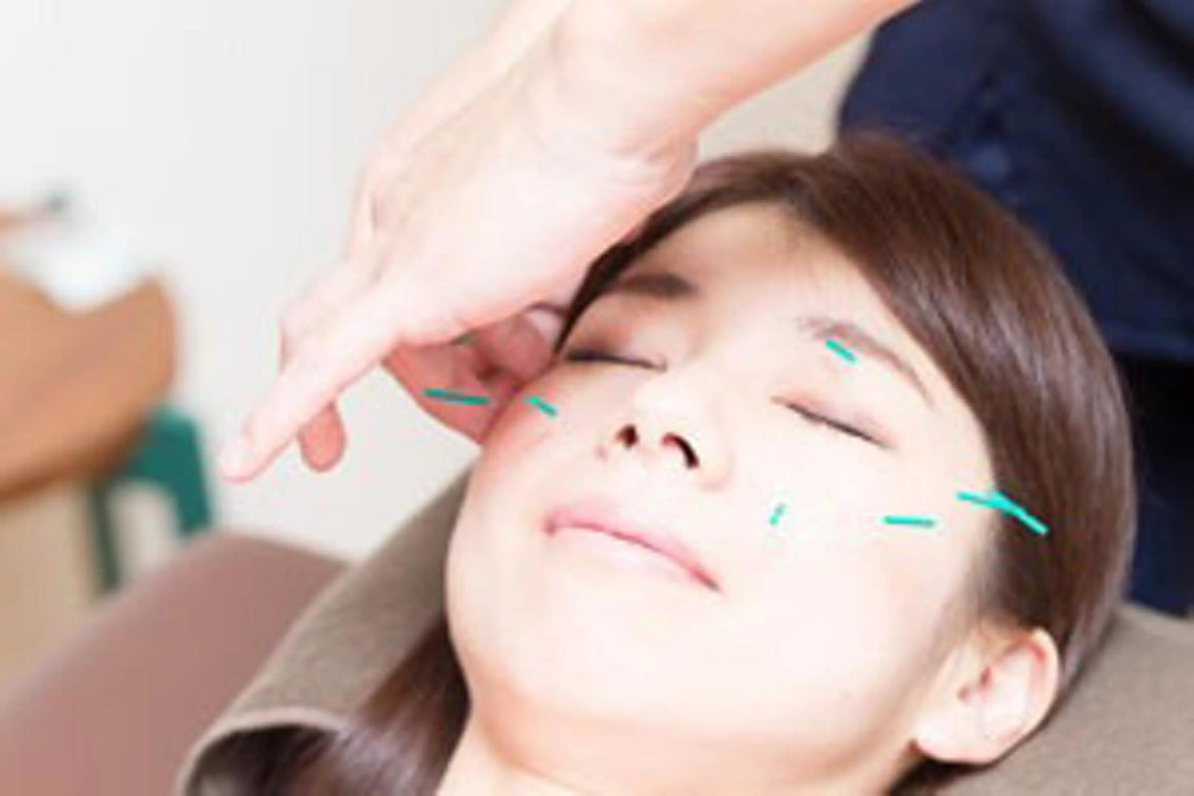 ✨g口コミを書いて頂ける方限定✨みこころ美容鍼コース 初回7700円→5280円 当院1番の人気コースです💁🏻♀️の写真