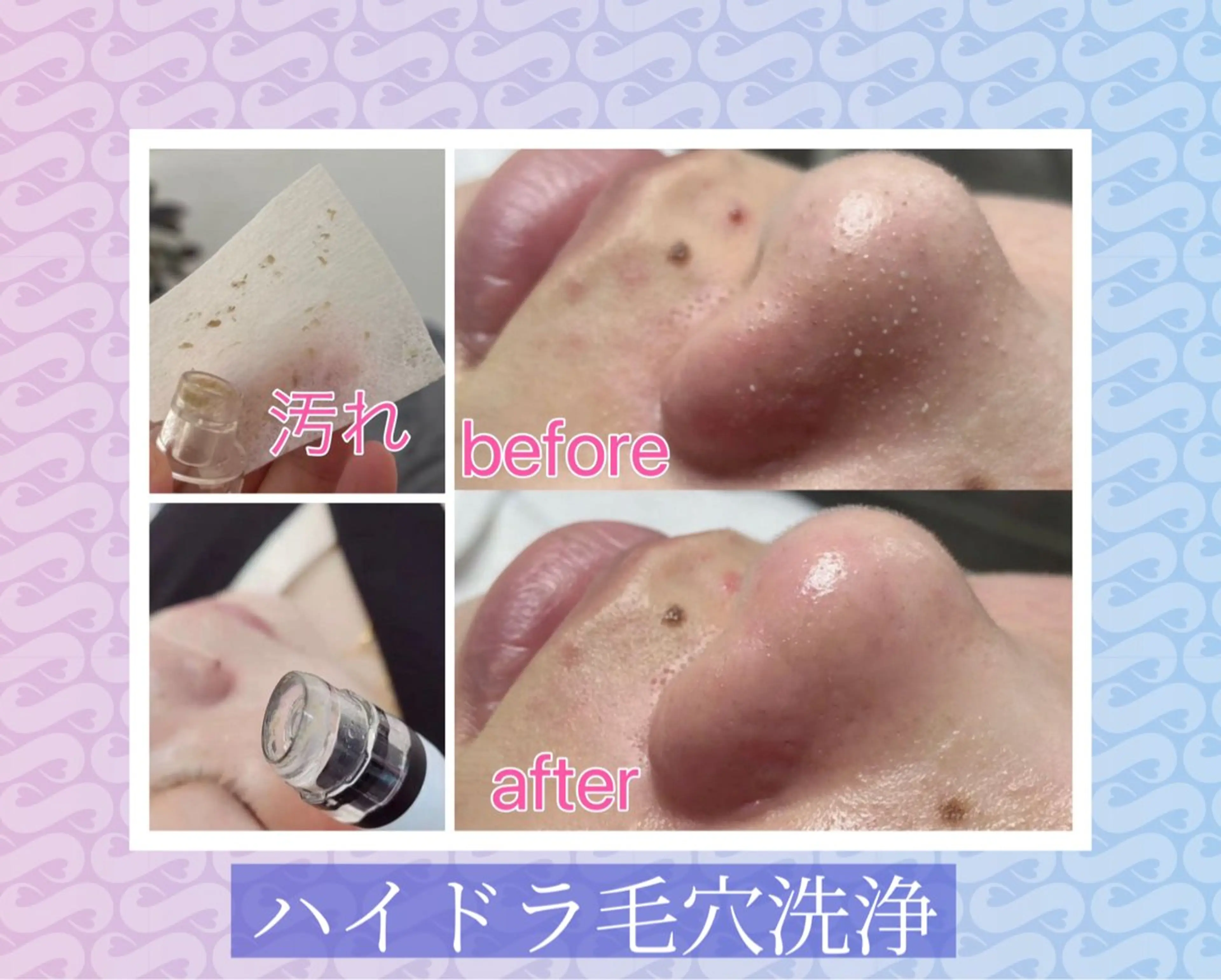 エステ 毛穴洗浄& 睫毛パーマ上野御徒町のマツエク・マツパデザイン