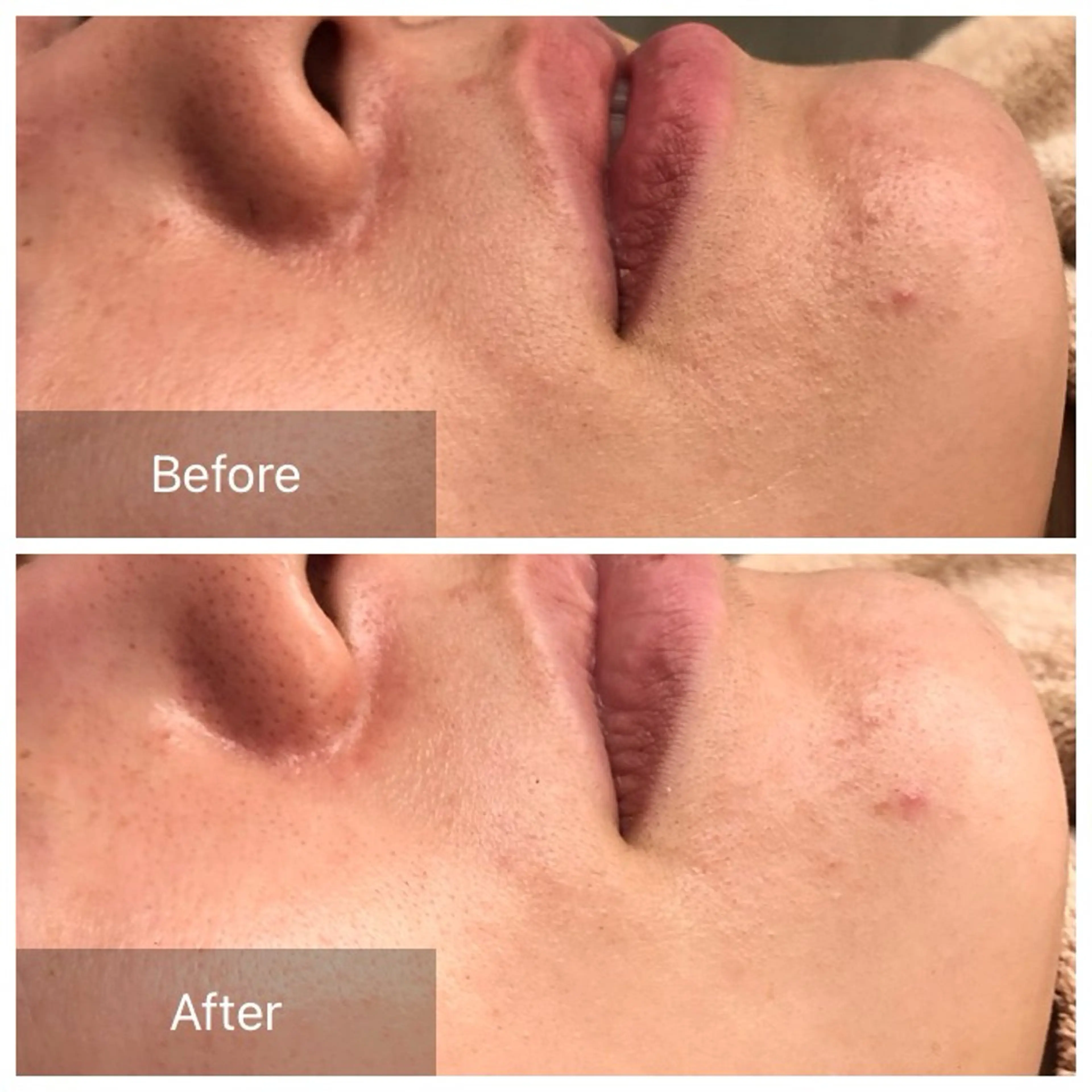 ハーブピーリング 肌再生ピーリング/のエステ・リラクイメージ