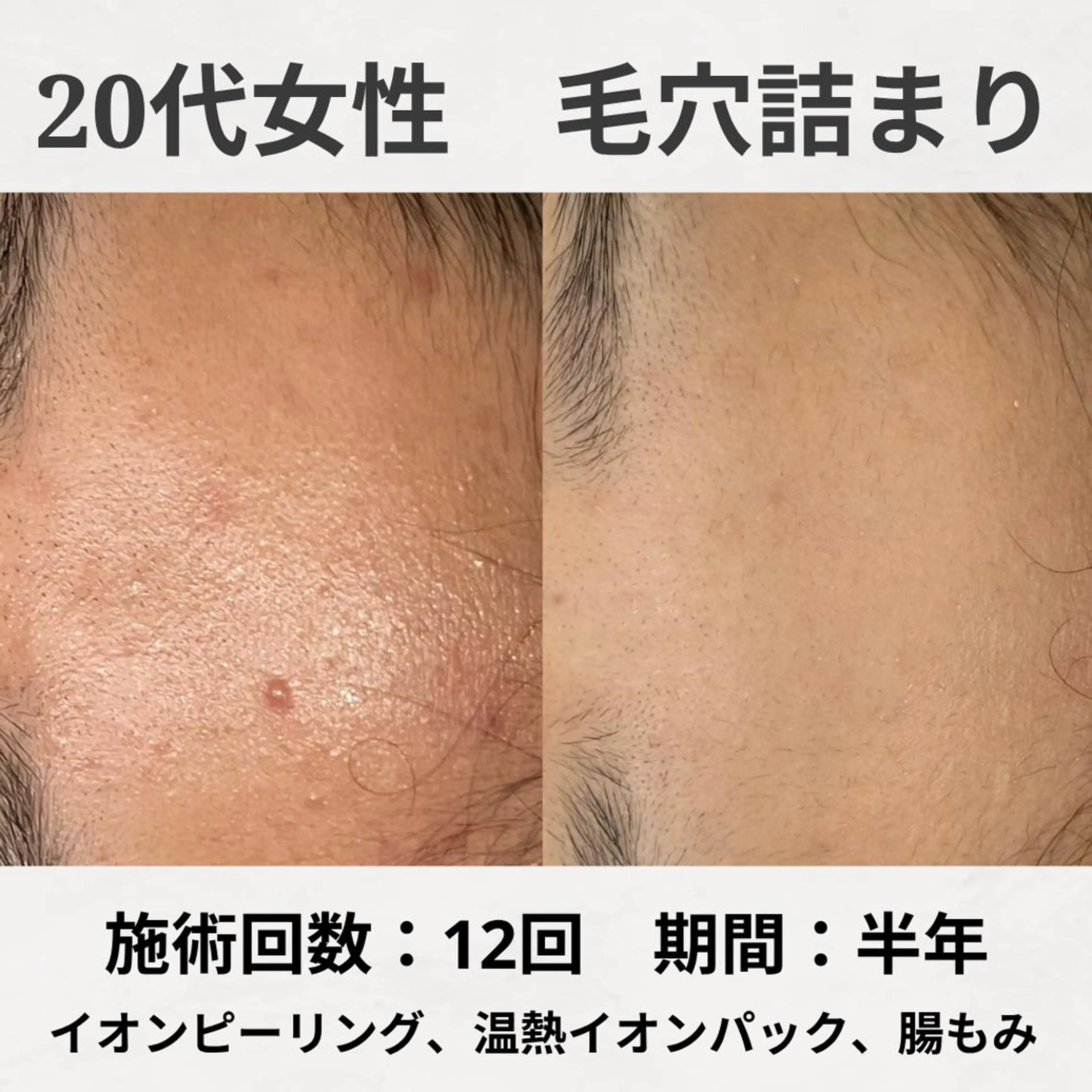 エステ リラク ニキビ跡改善専門🔥 医療にはできない改善のエステ・リラクイメージ