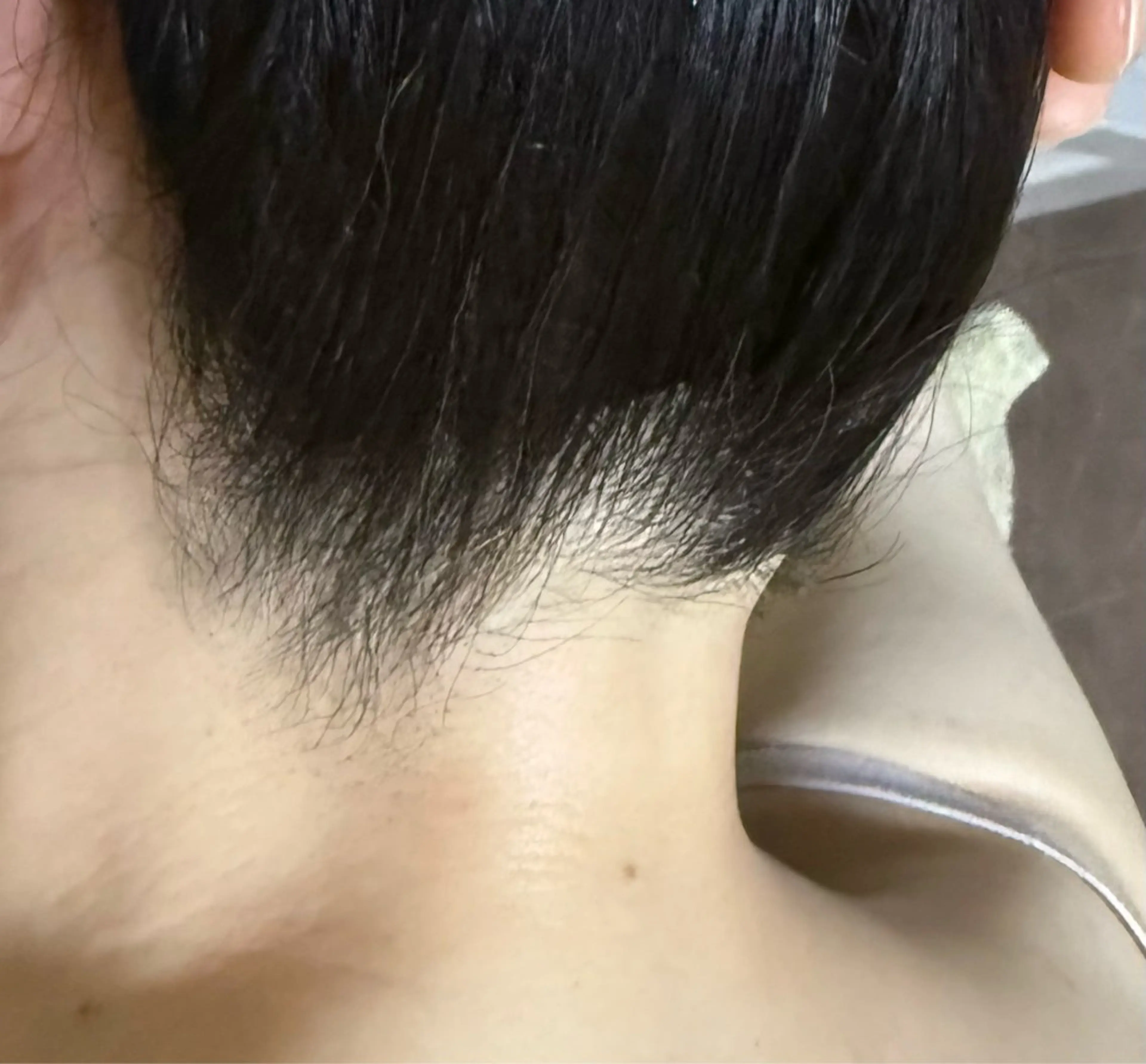 部分脱毛　襟足の写真