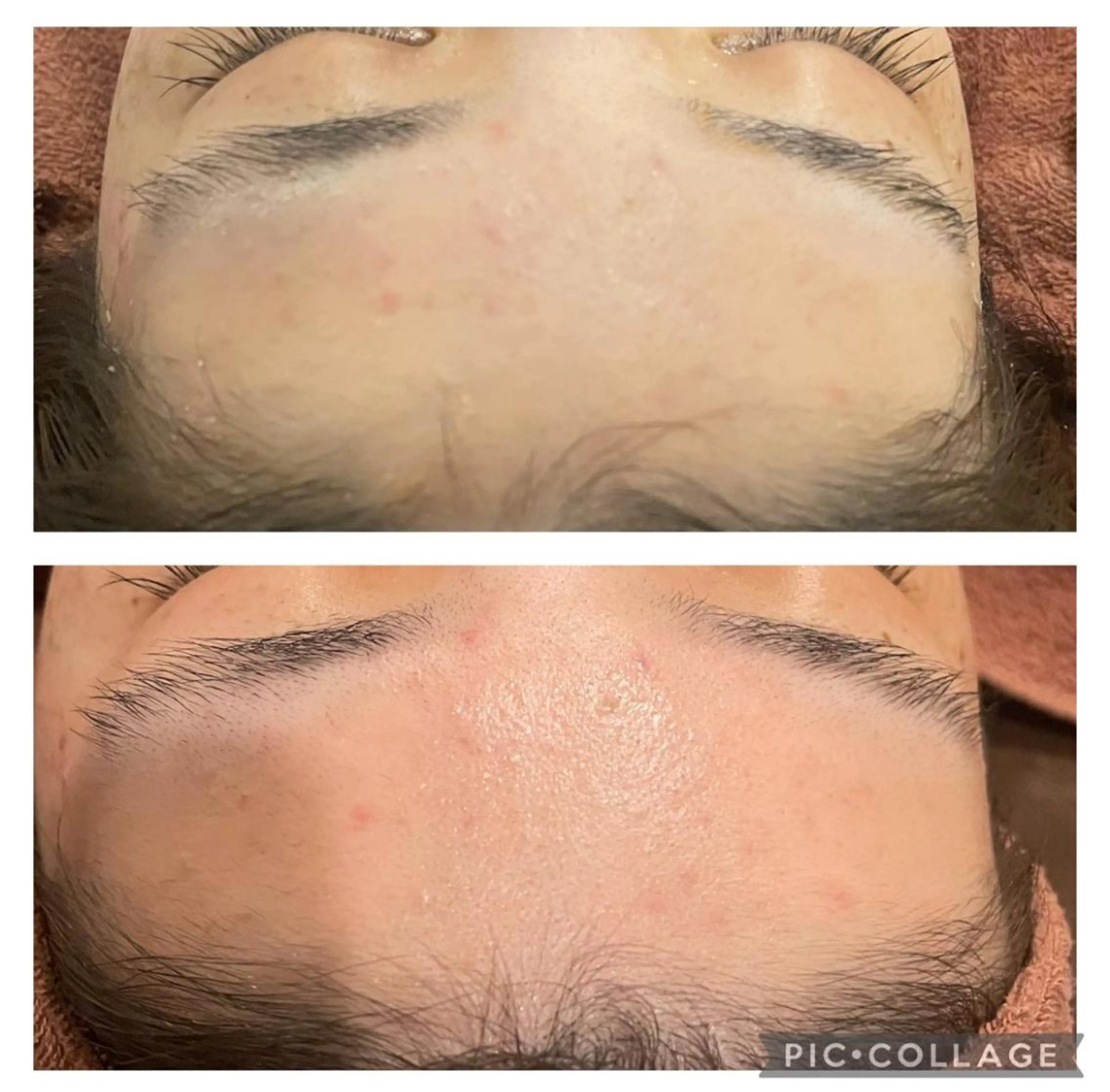 ニキビ跡改善専門🔥 医療にはできない改善のエステ・リラクイメージ