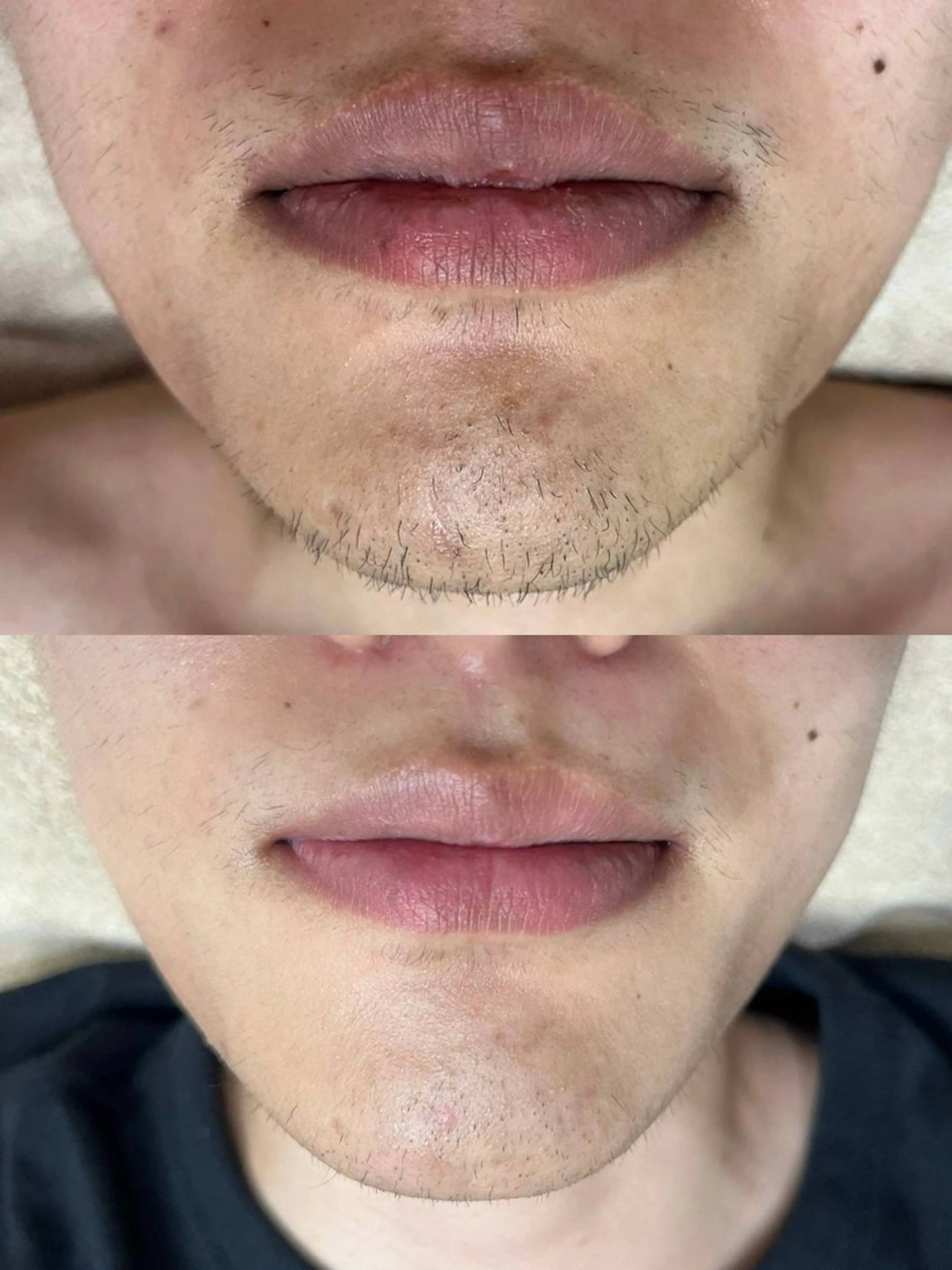 脱毛 韓国美肌/肌質改善 【天神】のエステ・リラクイメージ