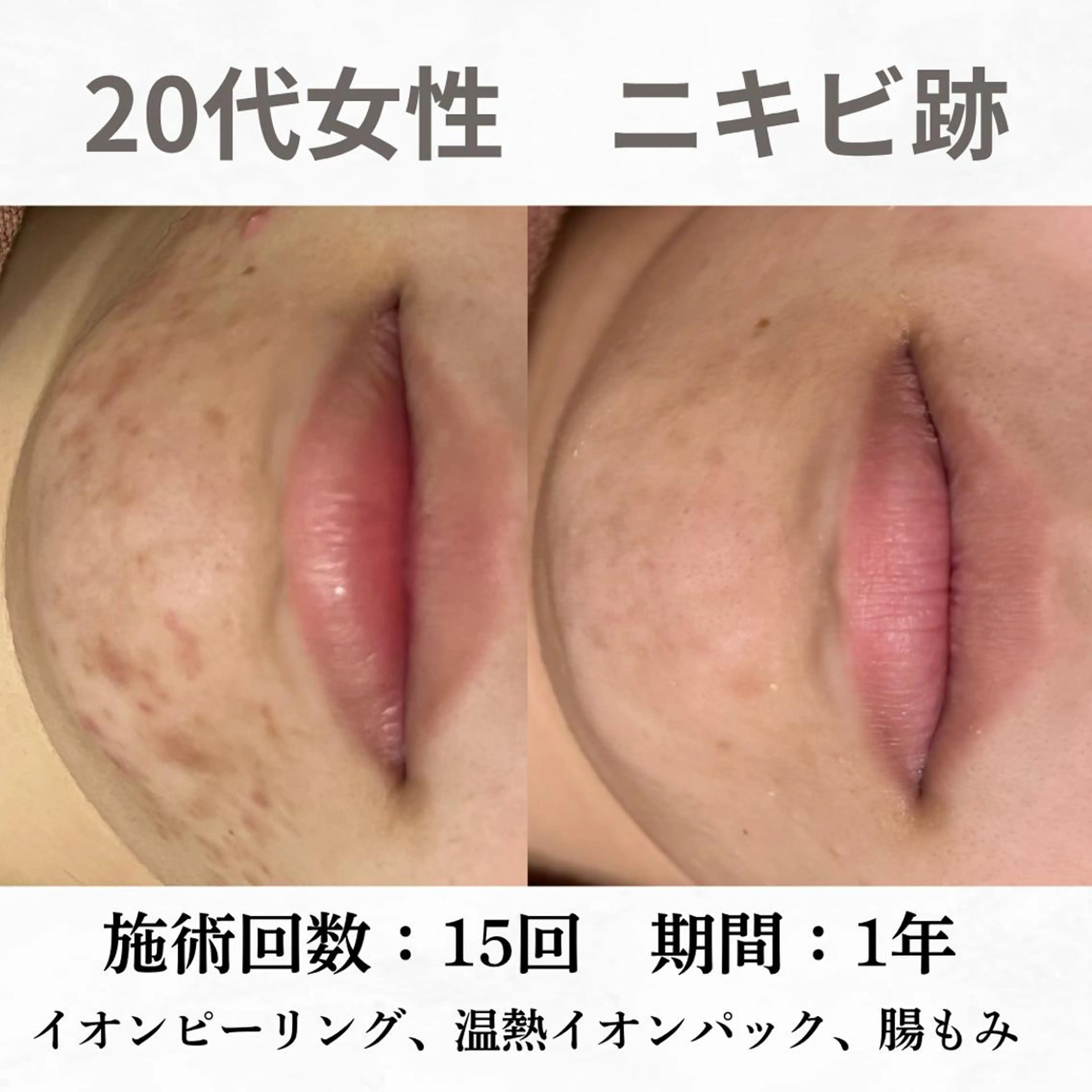 重度ニキビ専門🌷 ダウンタイムなしのエステ・リラクイメージ