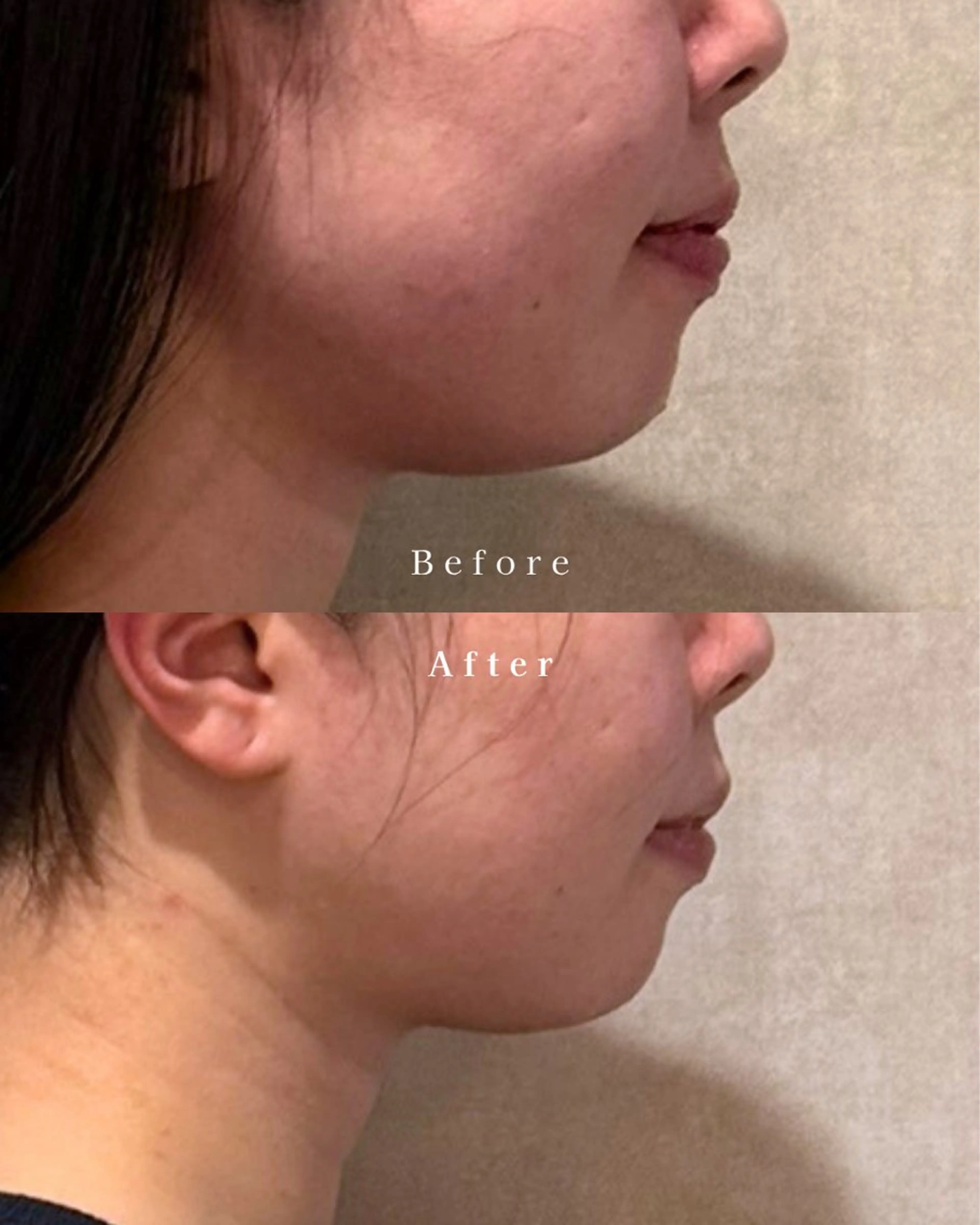 🎀˗ˋˏ 顔のむくみや二重顎にˎˊ˗🫧小顔リフトアップ・フェイスラインの写真