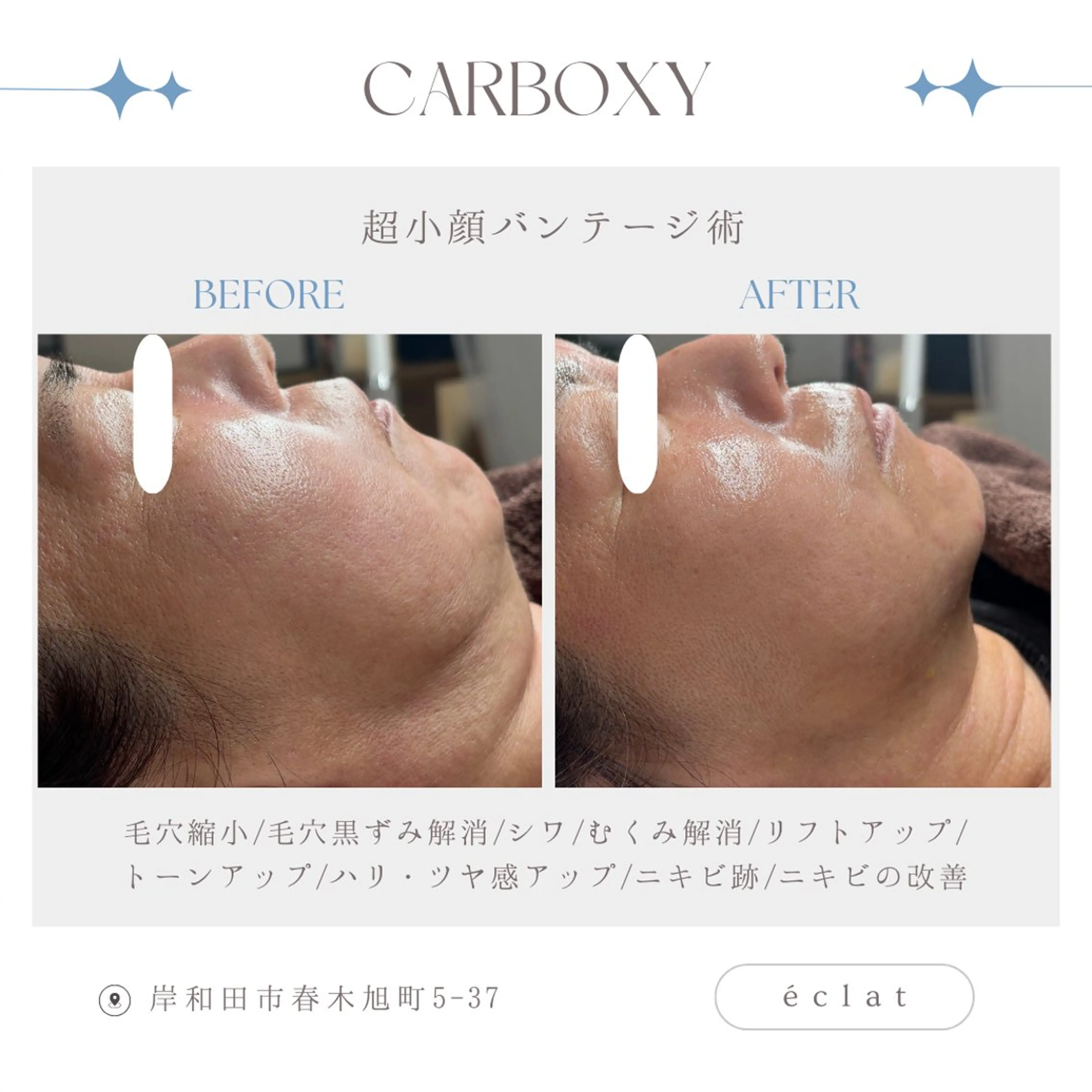 【毛穴×ニキビ×小顔】カーボキシートリートメントの写真