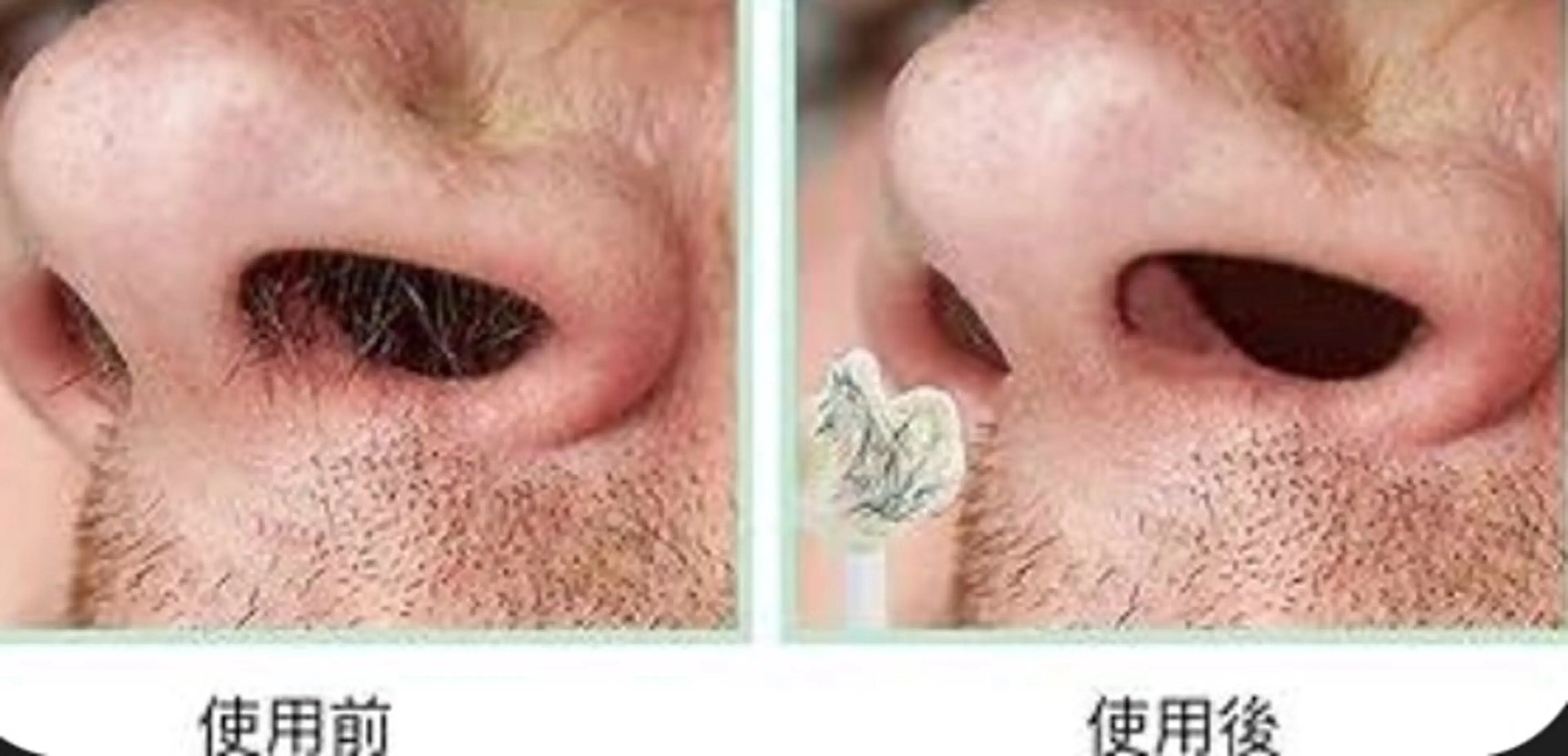 【WAX脱毛】鼻毛WAXの写真