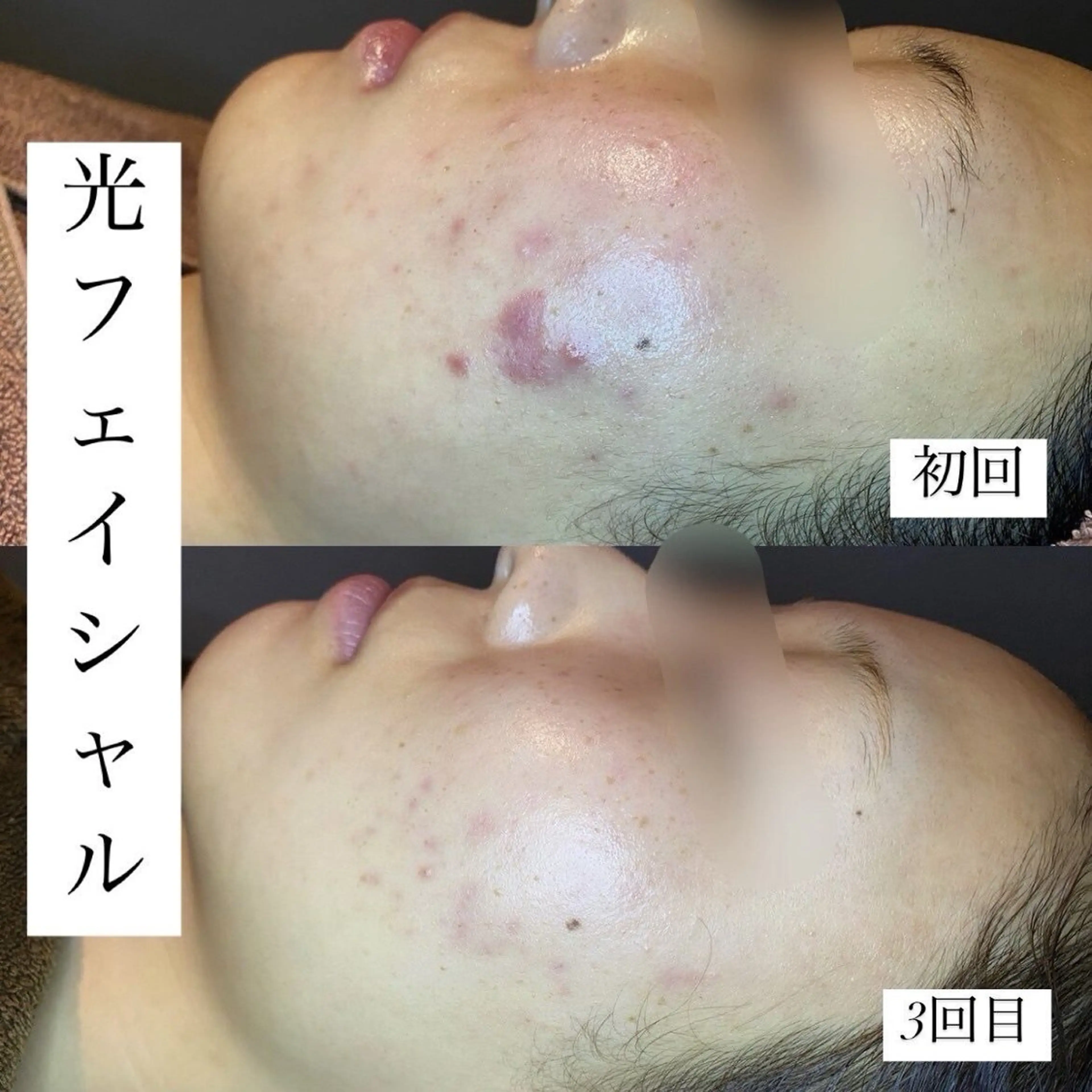 頑固な肌悩みに🍀光フェイシャル×コラーゲンパック🌈の写真