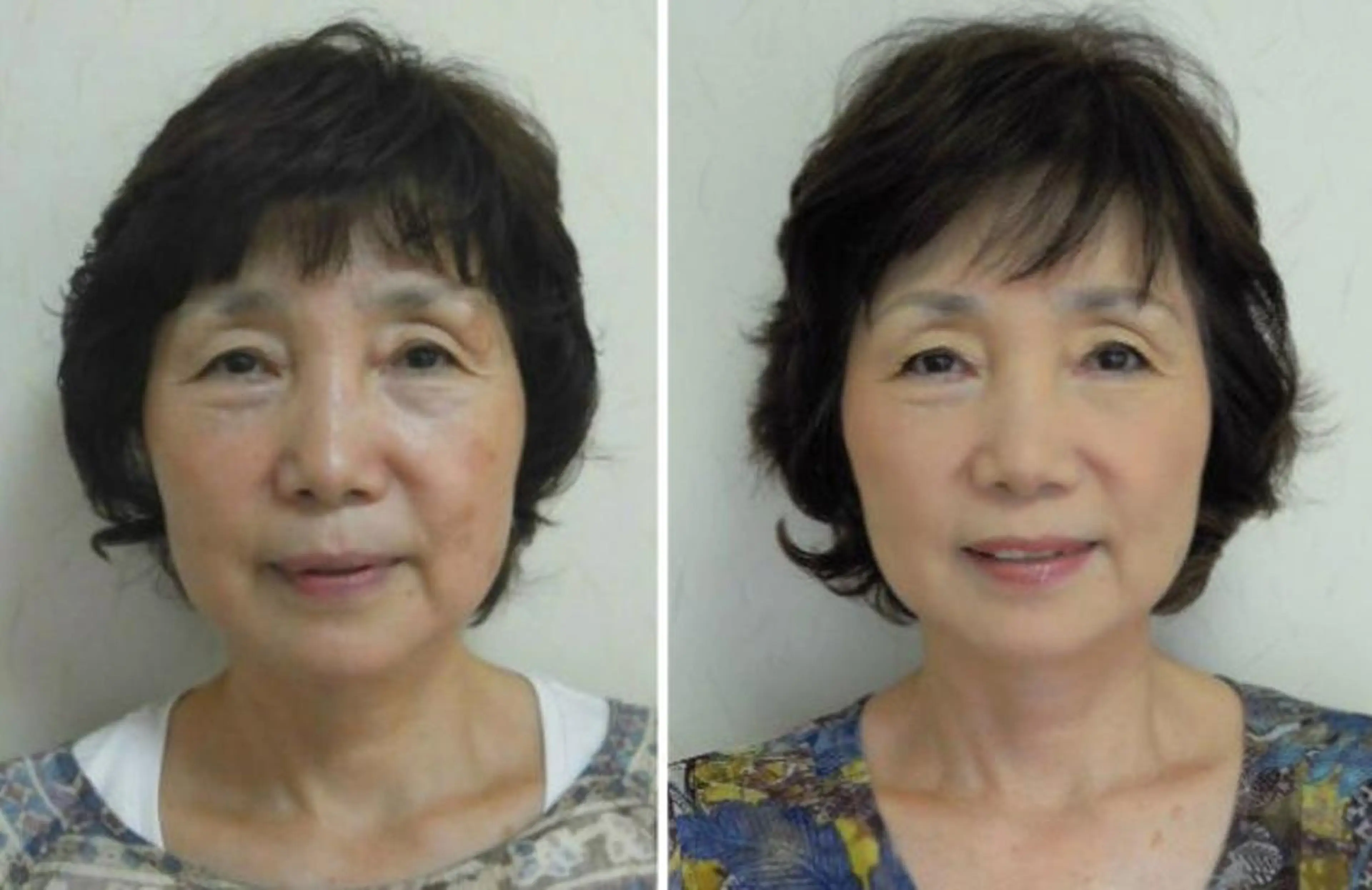 コスモリフト！点々と現れてきたシミ、たるみ、表情シワに◎の写真