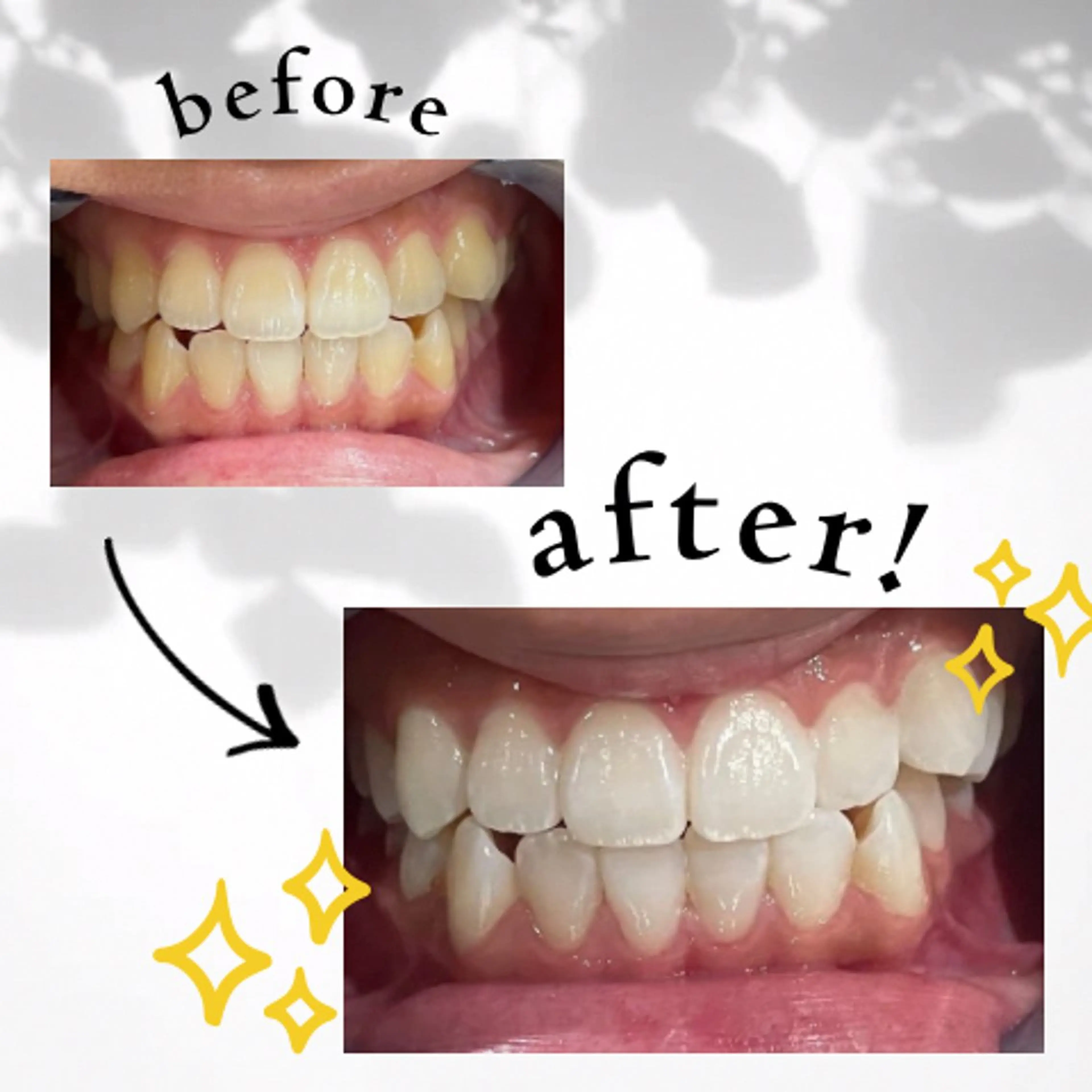 その他 セルフホワイトニング 都立大学🦷✴︎のその他イメージ