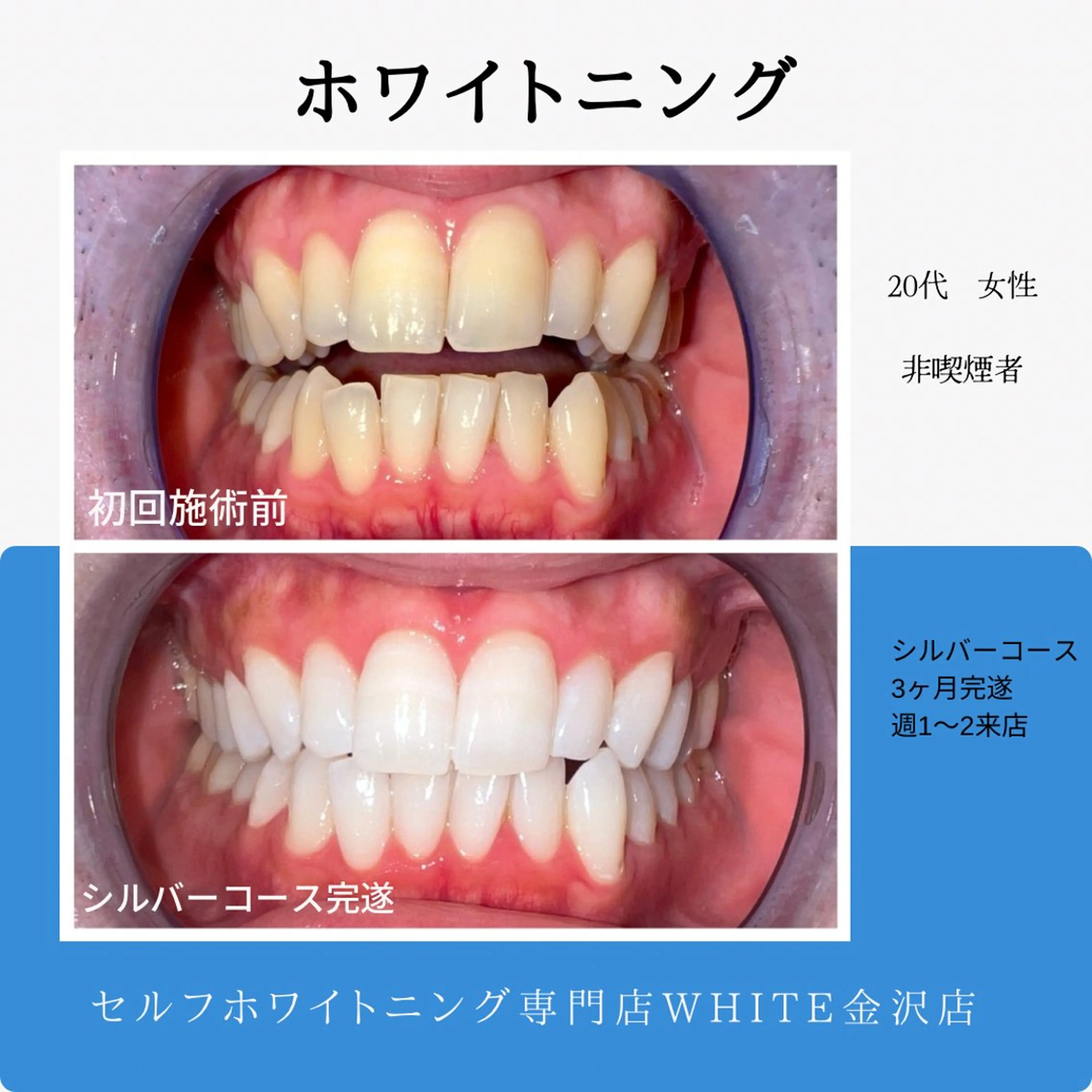 【短期集中ホワイトニングで白い歯に!】3ヶ月通い放題で理想の白さに!の写真