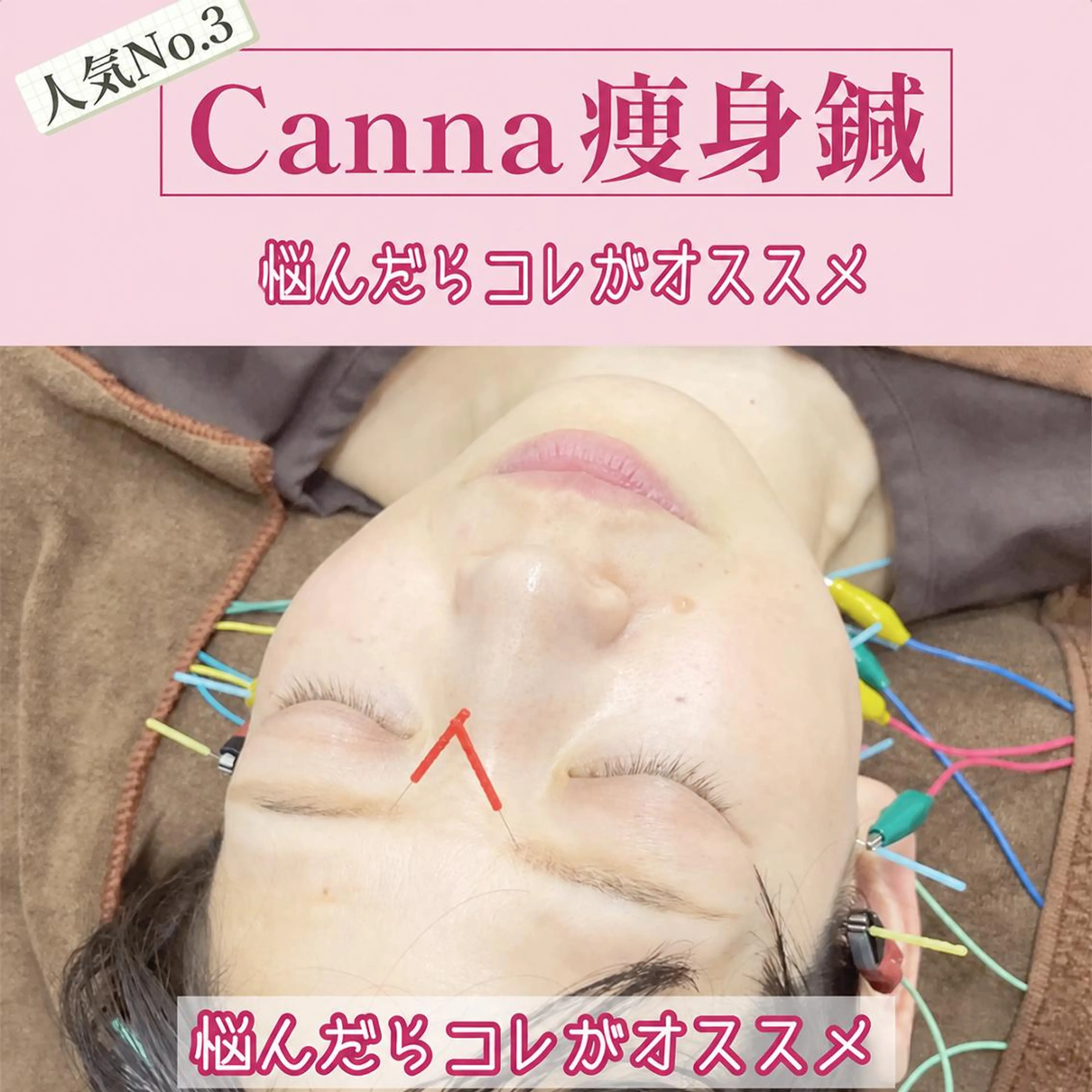 5/9限定！人気No.3【痩身針】⭐️たるみケア＆痩身特化！美容鍼＋痩身エステの写真