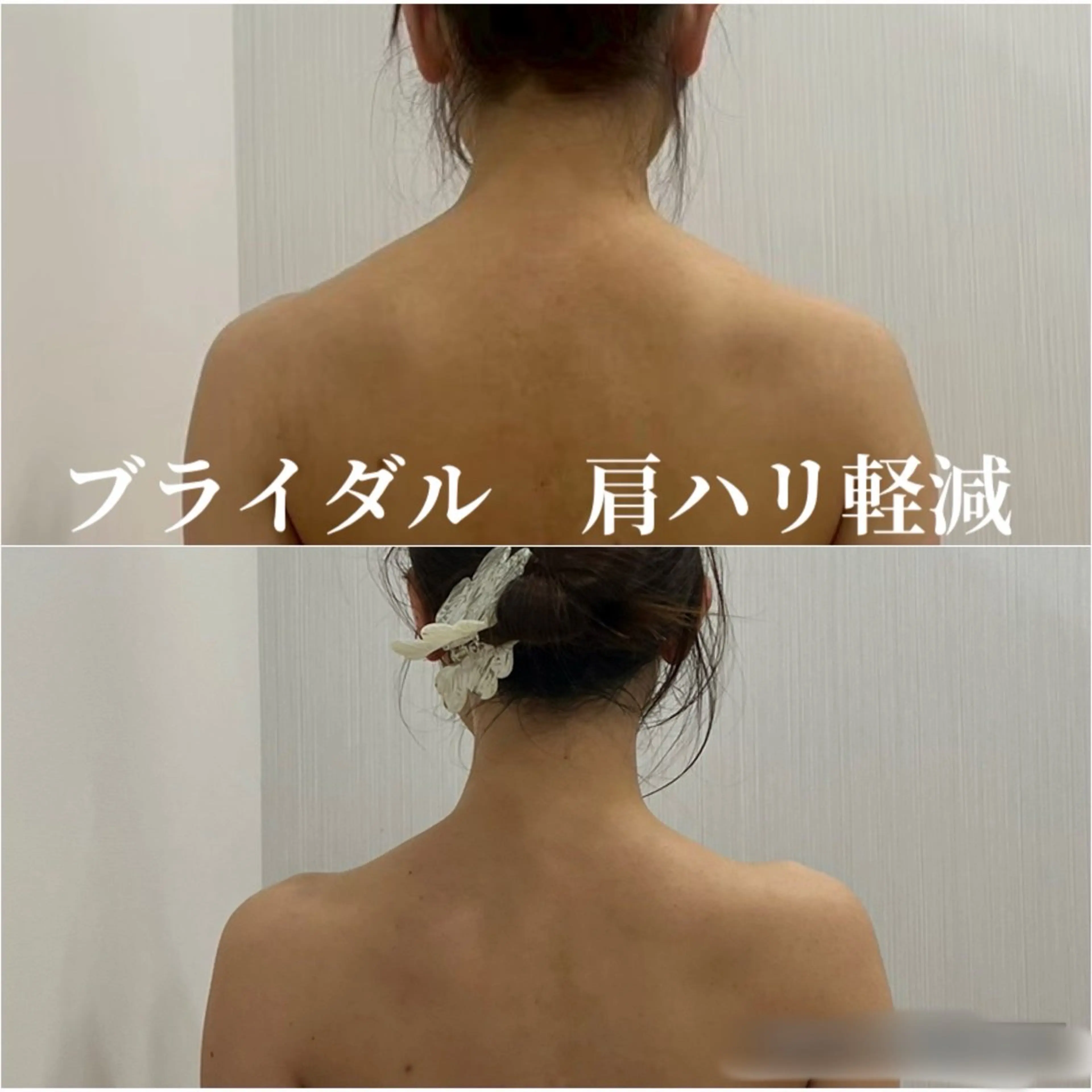 【都度ブライダル1DAY上半身集中コース】天使の羽×首肩ハリ×二の腕やせプラン90分でドレス映え★の写真