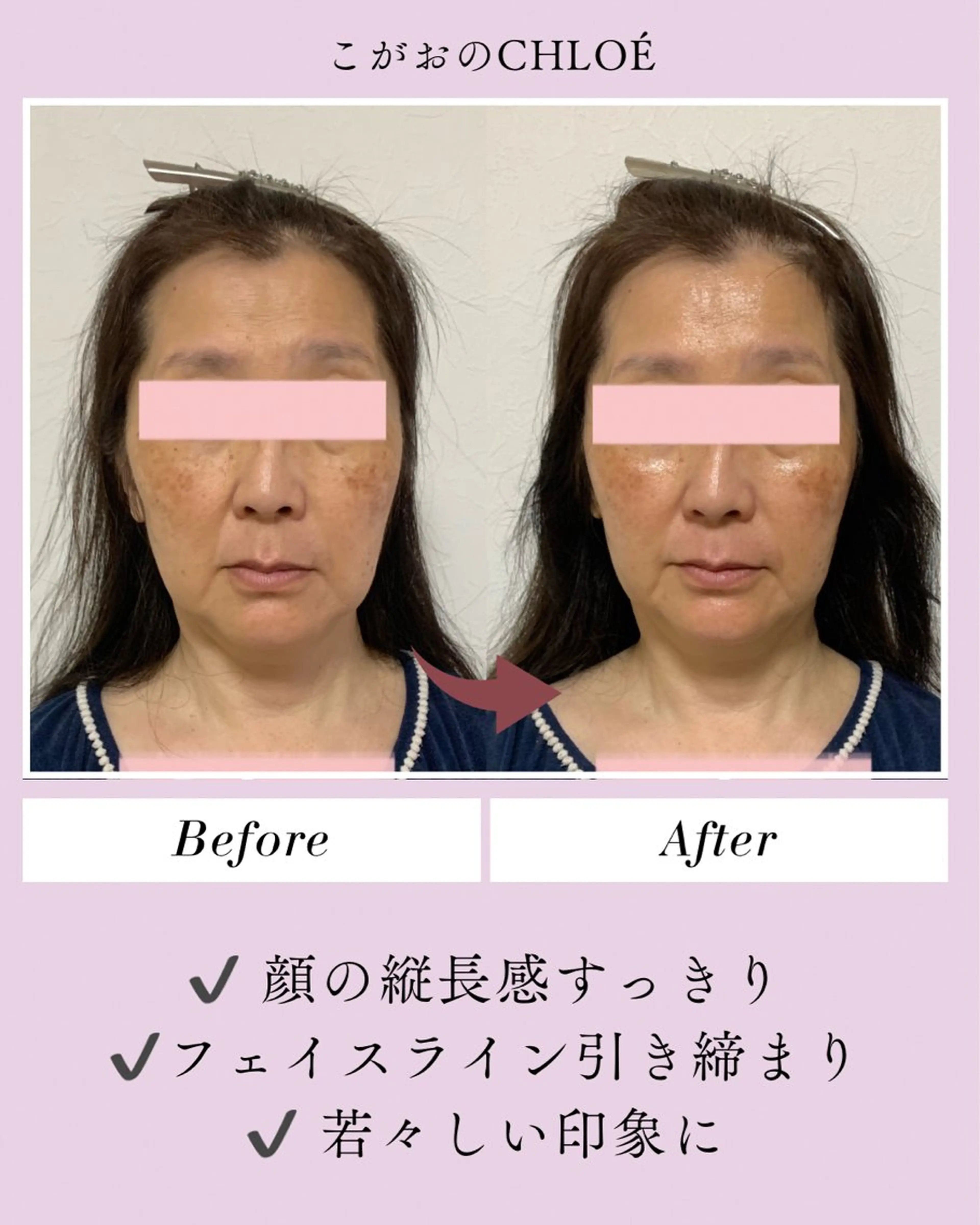 小顔サロン こがおのCHLOÉのエステ・リラクイメージ