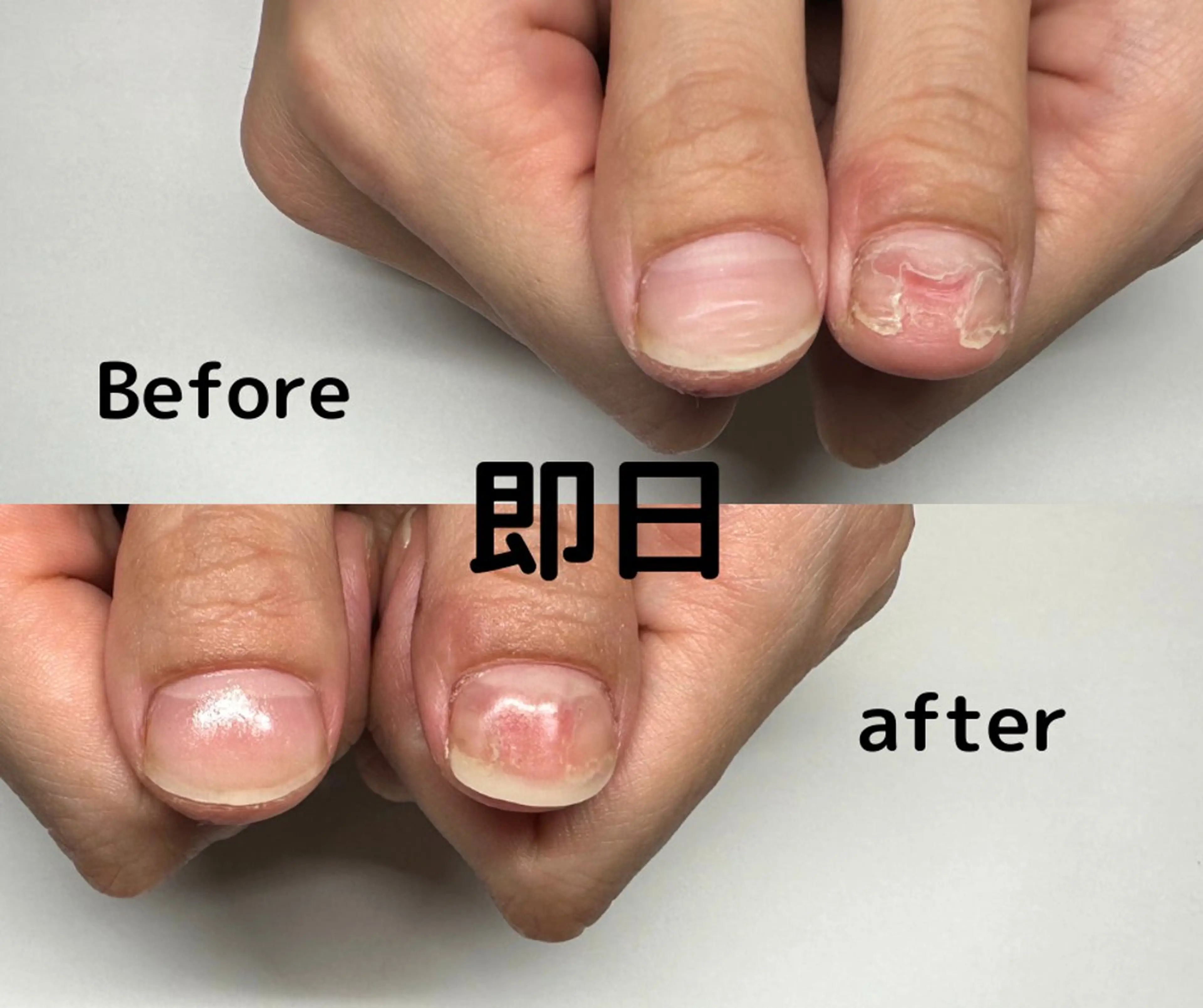 ネイル 深爪矯正専門店ネイルサロンKUU所属・深爪矯正専門店 ネイルサロンKUUのネイルデザイン