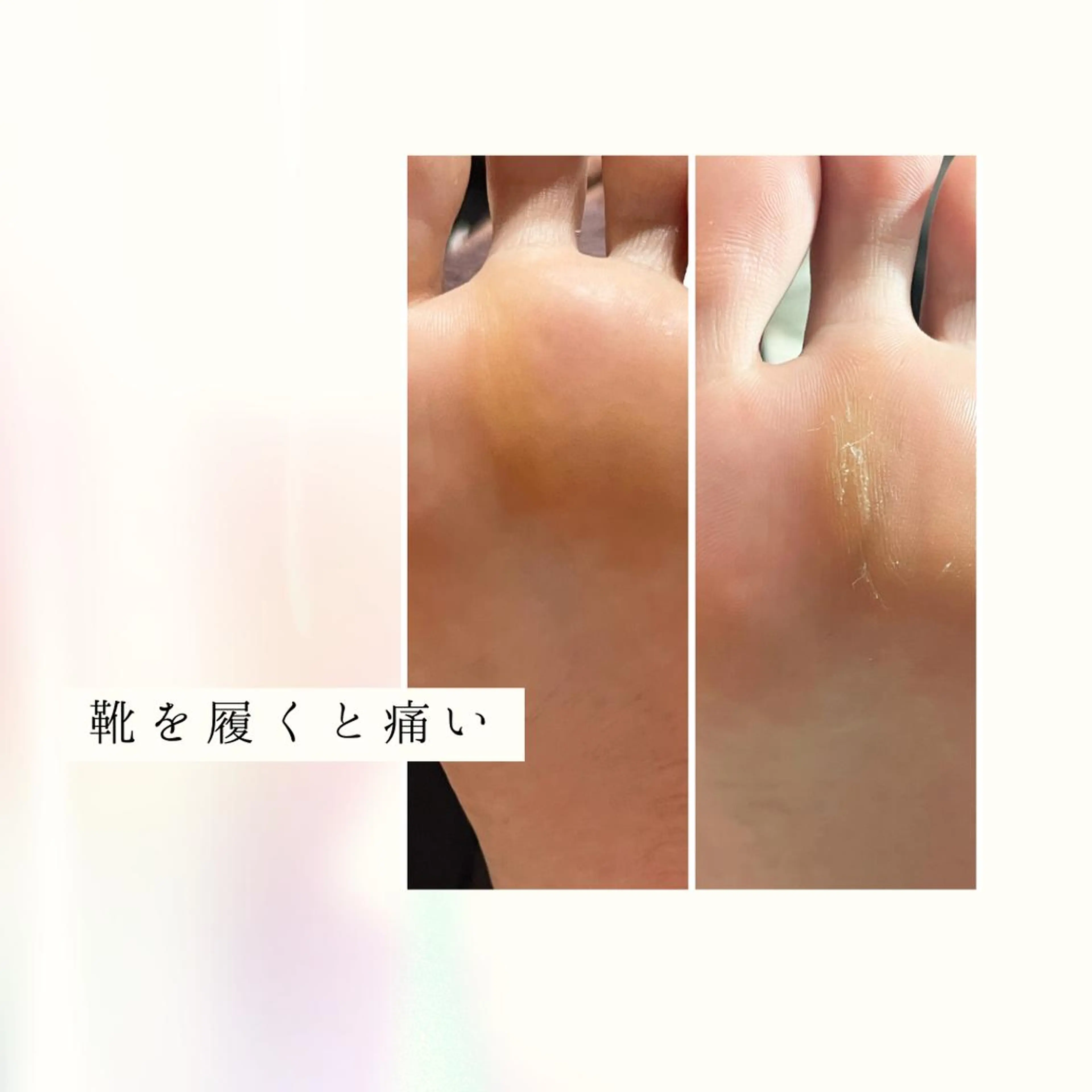 人気No.1🫶🏻🌿足裏タコ 角質ケア、保湿込みコース🦶ふっくらモチモチ✨見せれる足裏に🦶の写真