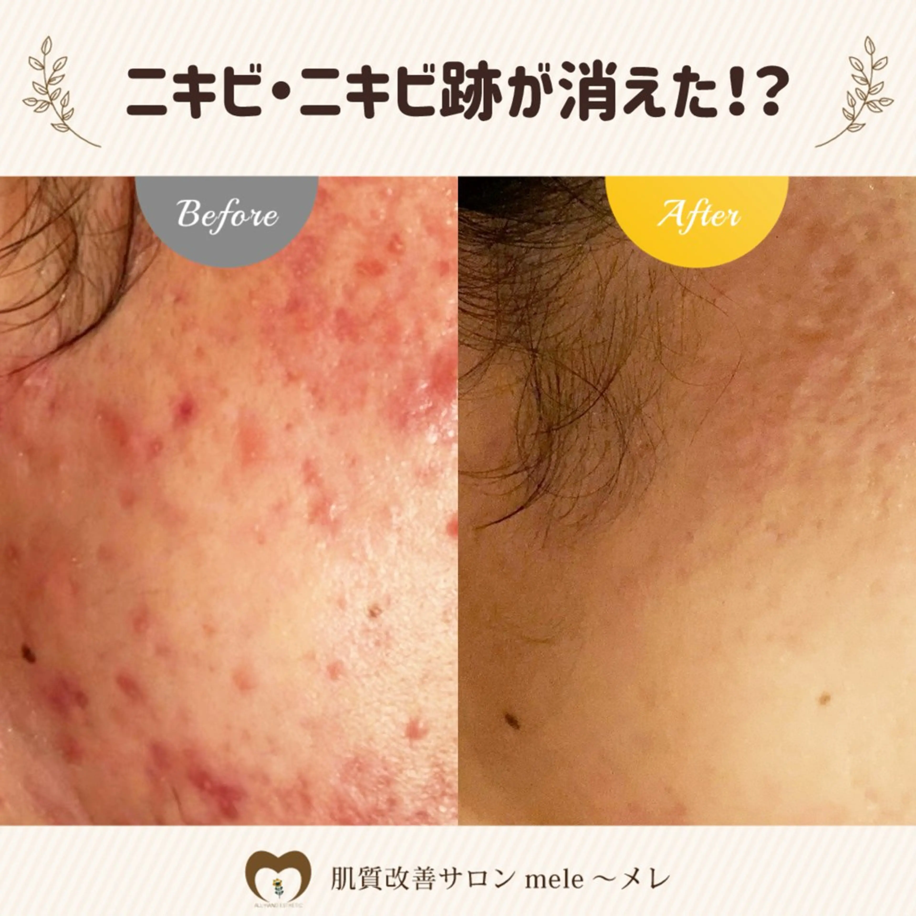 繰り返すニキビ・毛穴 ✨つくば肌質改善専門のエステ・リラクイメージ