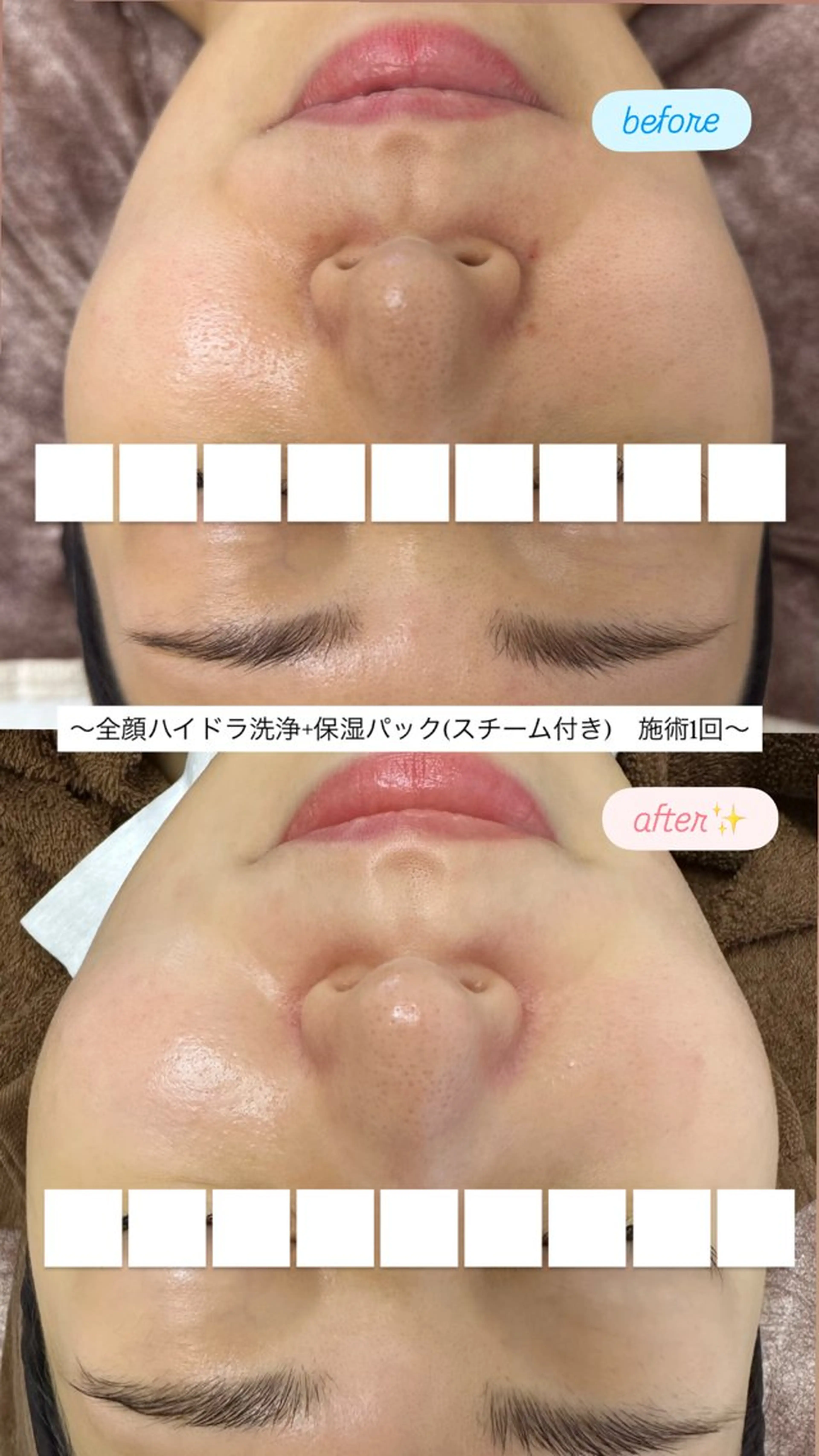 《毛穴のざらつき・つまり解消❣️》ピーリング×ハイドラ毛穴洗浄+水光パック✨の写真