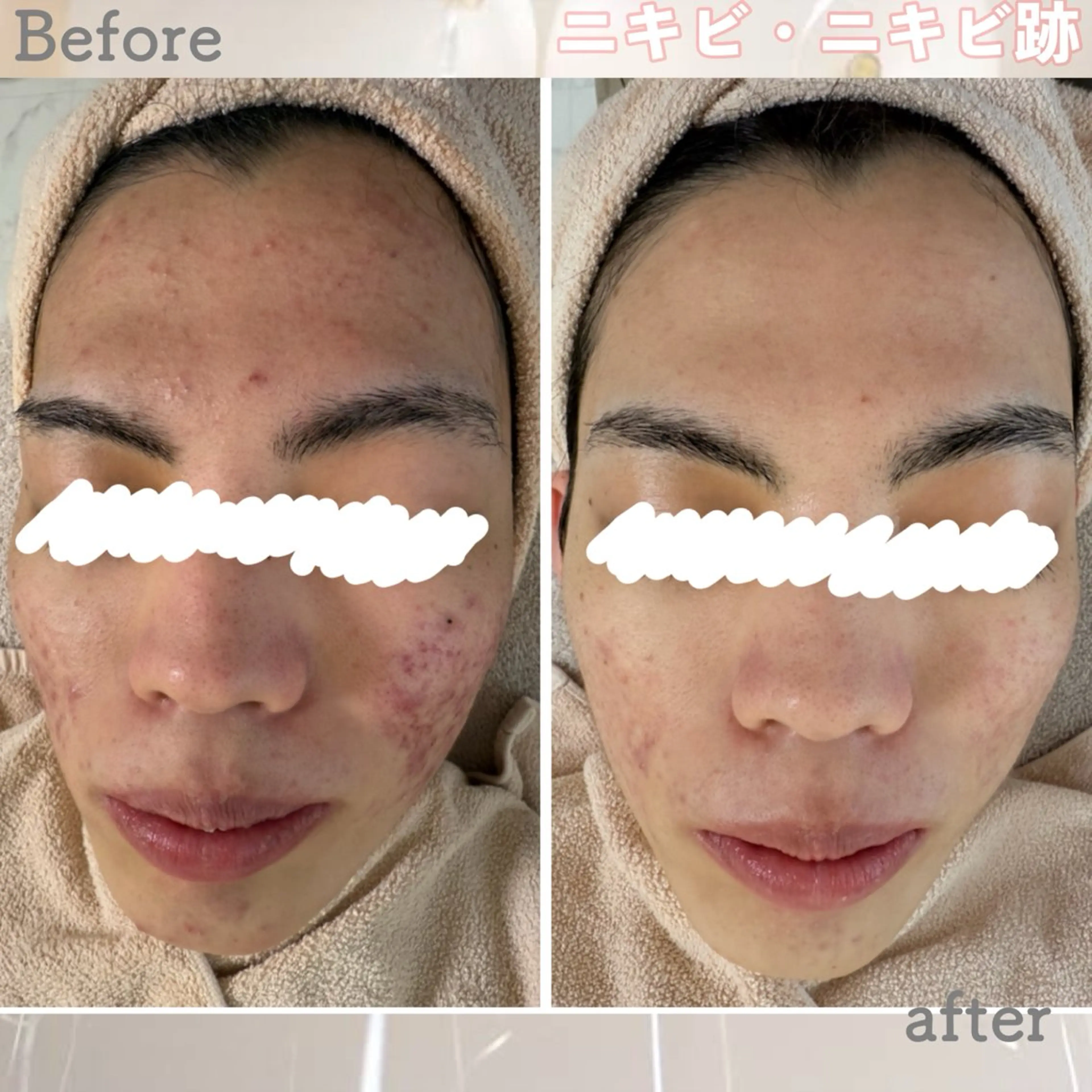 エステ ニキビ&跡改善サロン オーナー光木のエステ・リラクイメージ