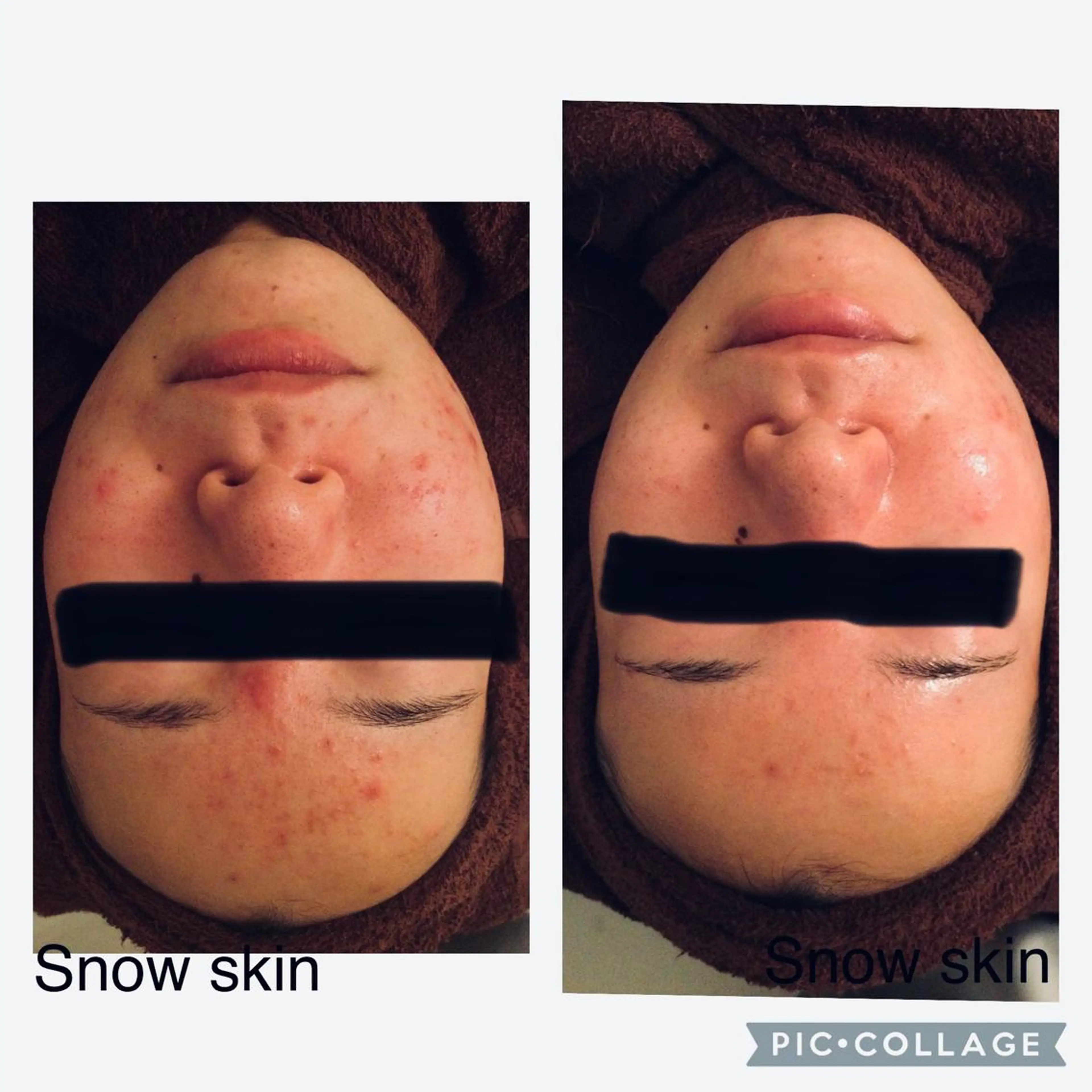 エステ リラク ニキビ/肌質改善専門 Snow skinのエステ・リラクイメージ