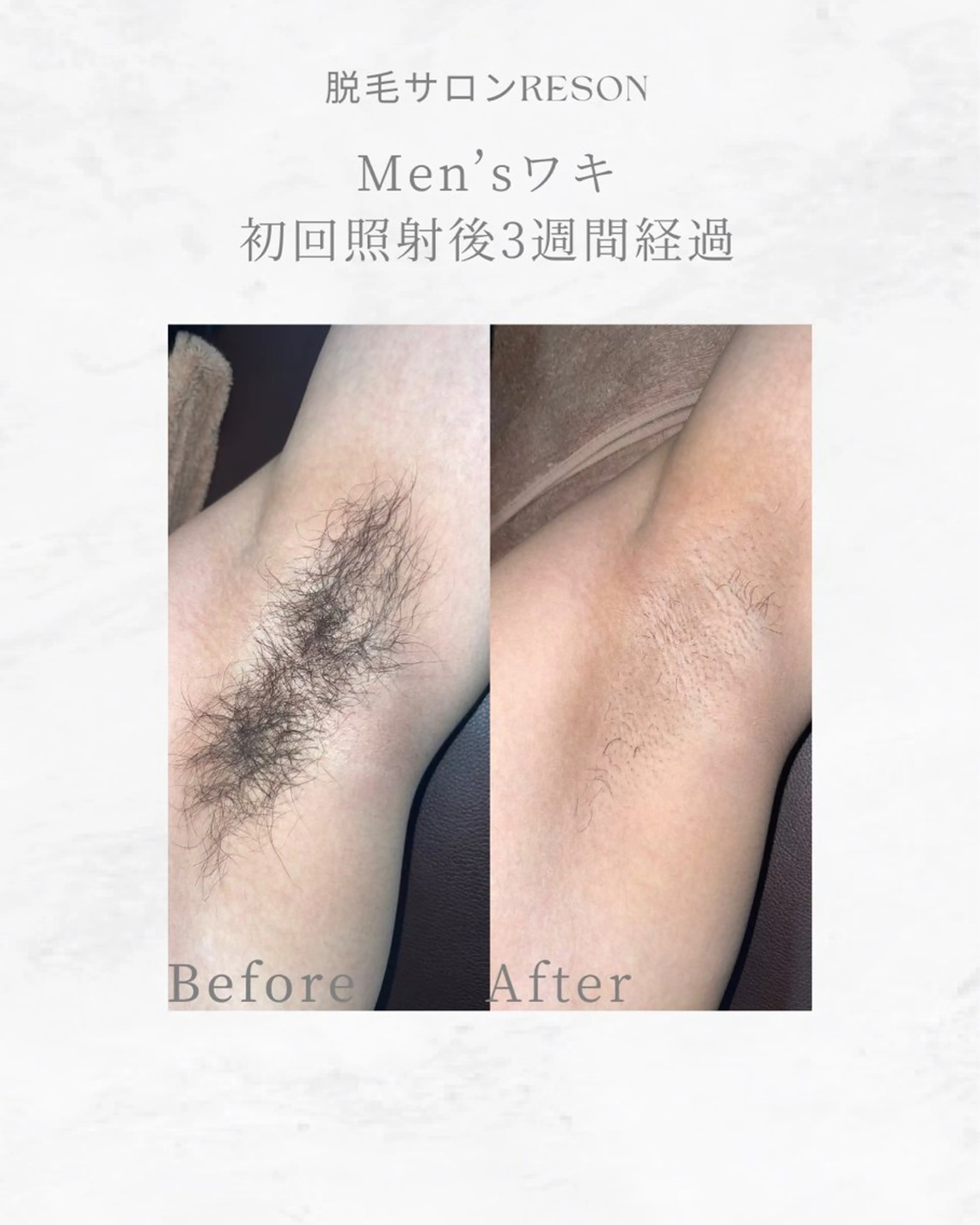 メンズ全身脱毛（ヒゲ・VIO除く）の写真