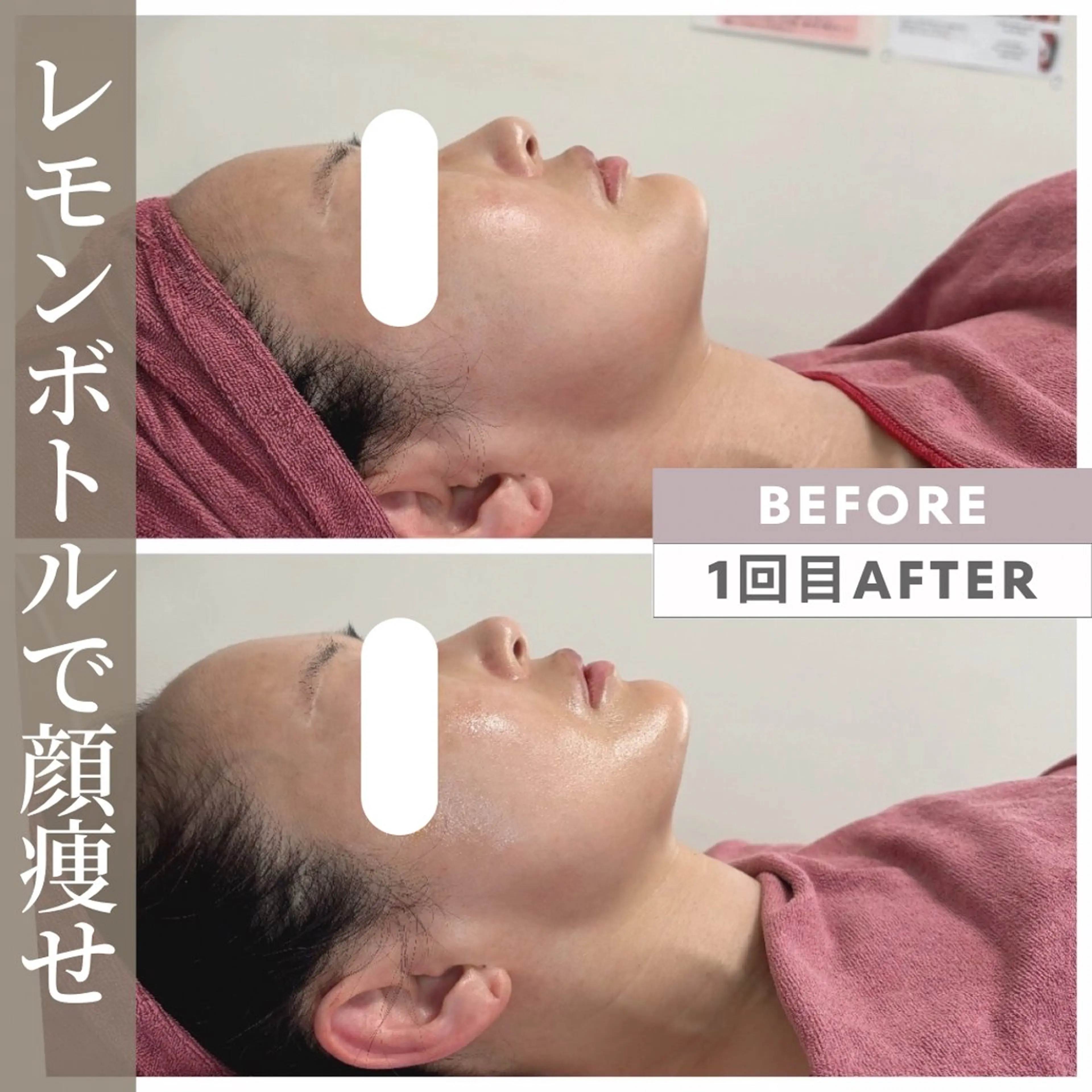 【4月13日限定】RFリフト×小顔矯正 × 脂肪撃退RED SHOT❤️ ¥12,800-【二重アゴ・頬肉・小顔】の写真