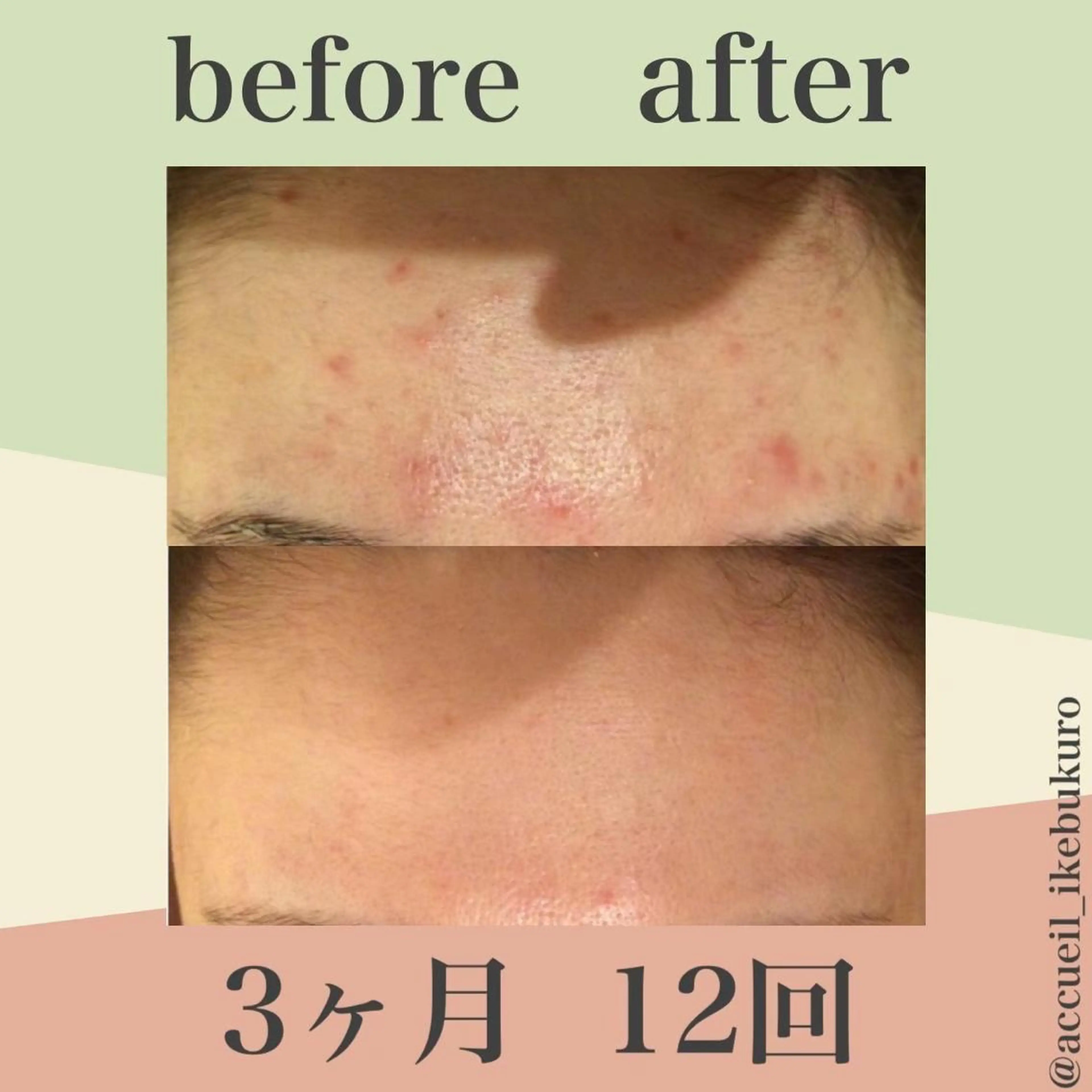 ミディアム カラー パーマ ヘアアレンジ メンズ キッズ ネイル マツエク・マツパ エステ リラク ニキビ・肌質改善専門 ♡人生が変わるサロンのエステ・リラクイメージ