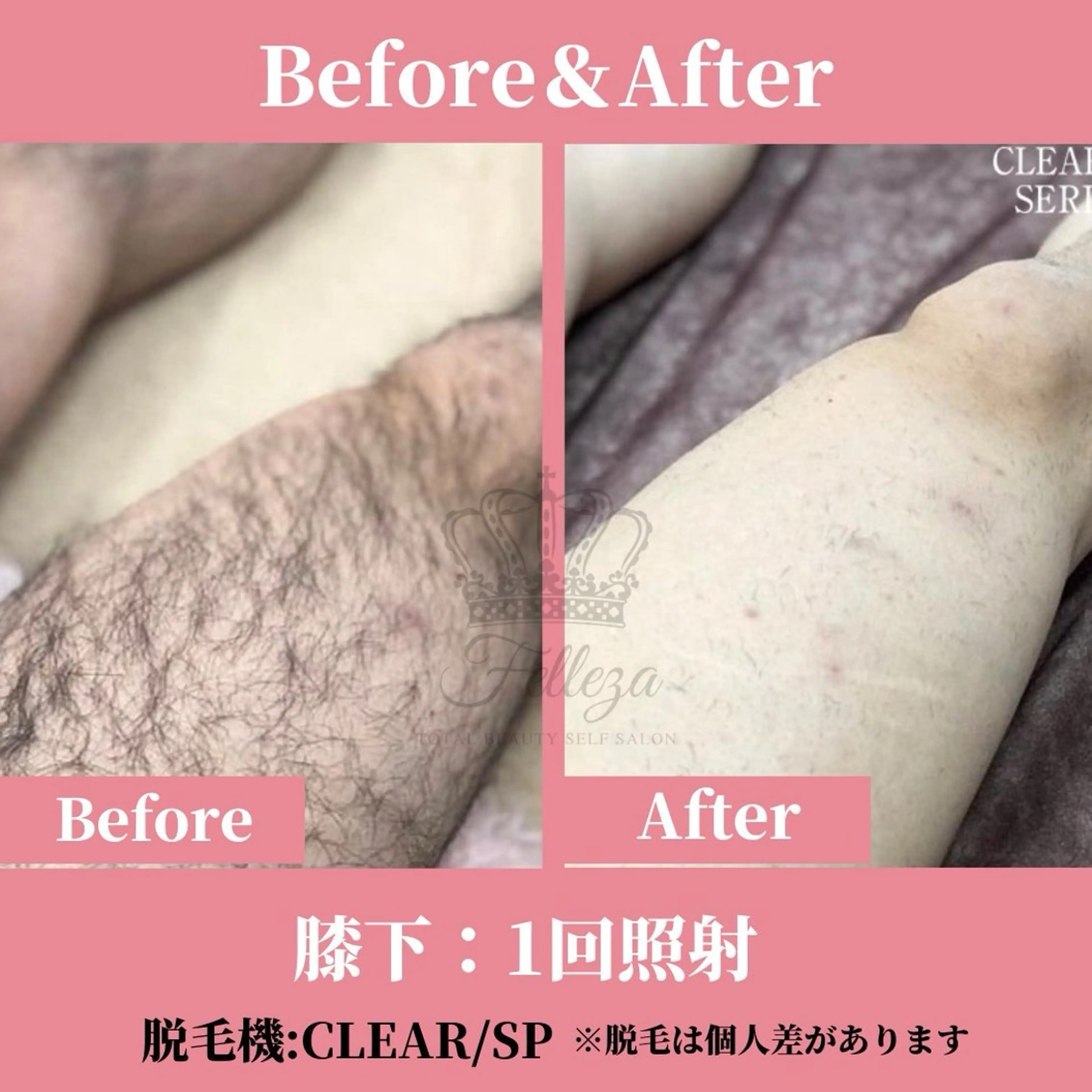 【男性限定/スタッフ施術】お顔/VIO/全身脱毛☆極上美肌脱毛コース☆の写真