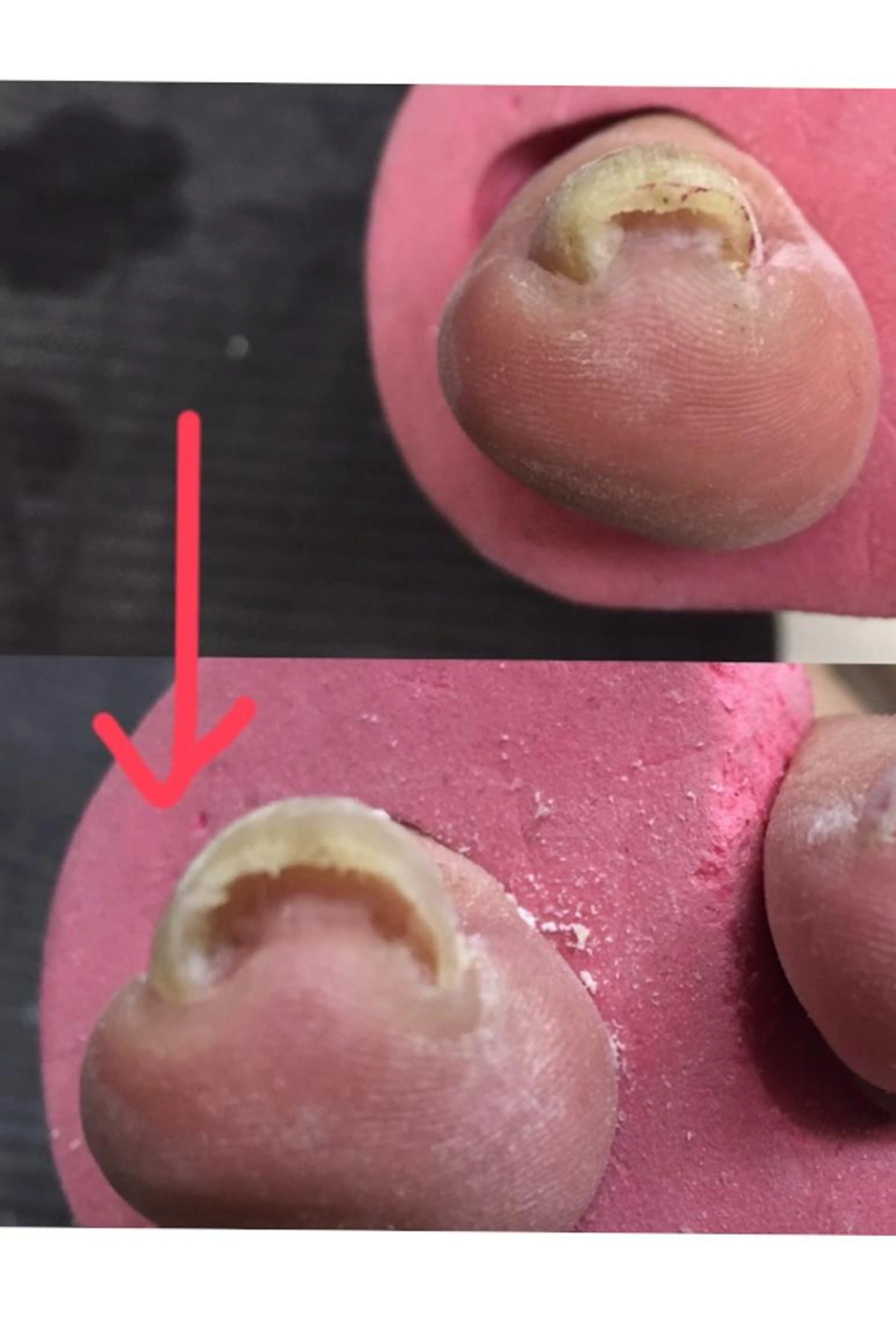 ❣️巻き爪矯正1本(ケア込み)❣️の写真