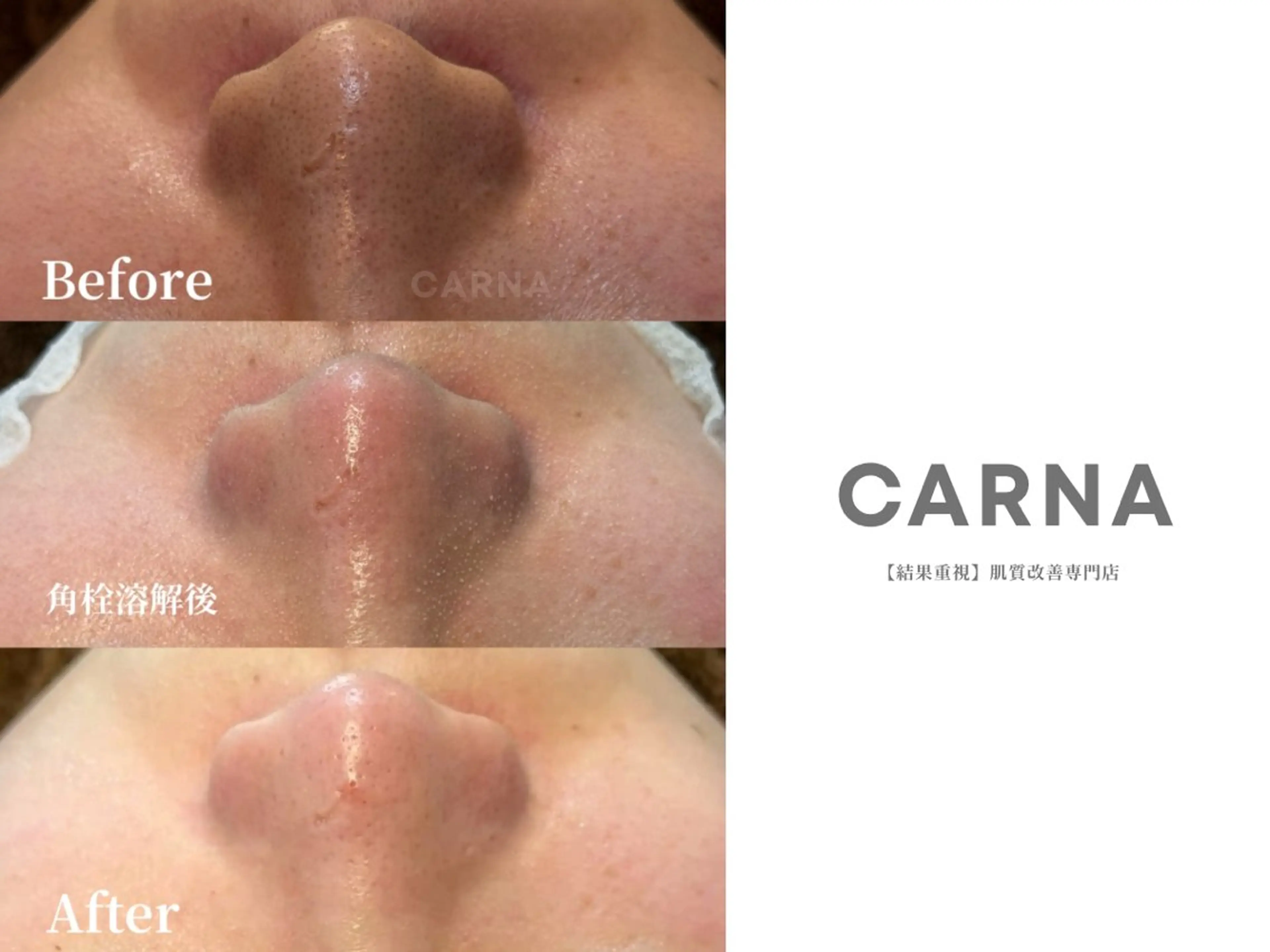 【脱！黒ずみいちご鼻】サクッと鼻だけ★3D毛穴洗浄（ハイドラ）の写真