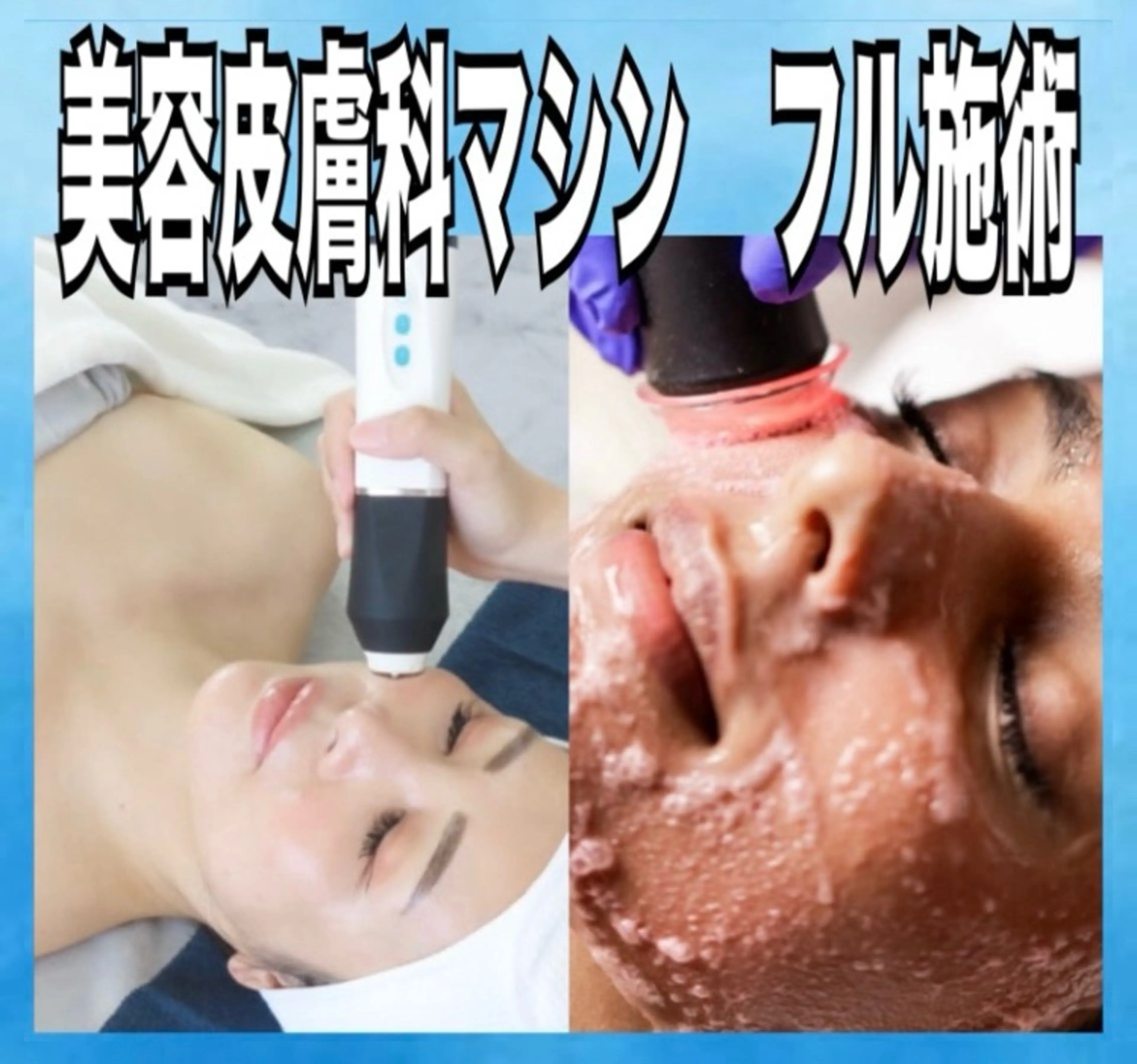 驚愕効果🔥半額以下‼️美容皮膚科マシン💎【小顔＆毛穴ケア】ジェネオ＋フル施術（肩デコルテマッサージ付き）の写真