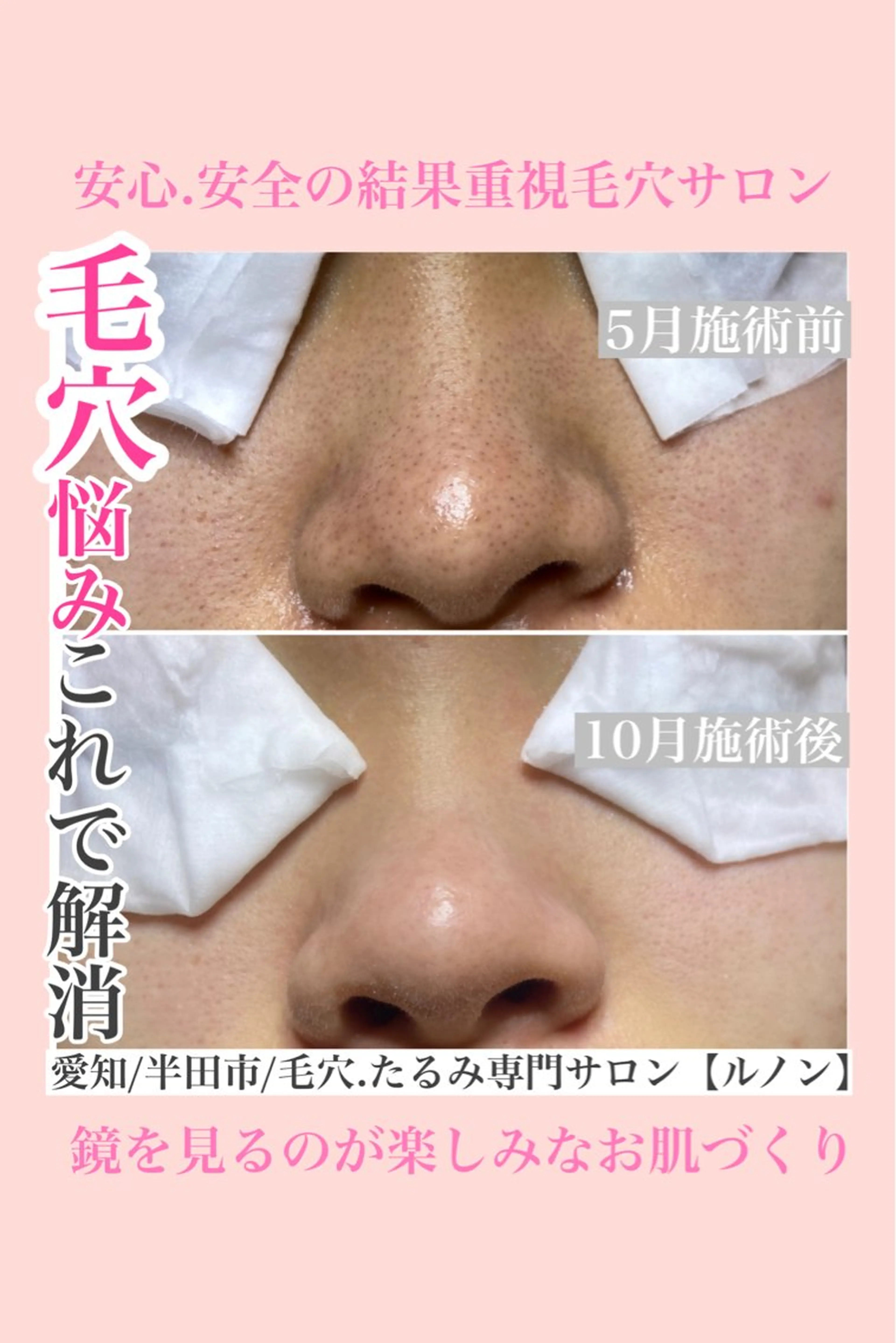 毛穴エクストラクションプロの毛穴美人コースの写真