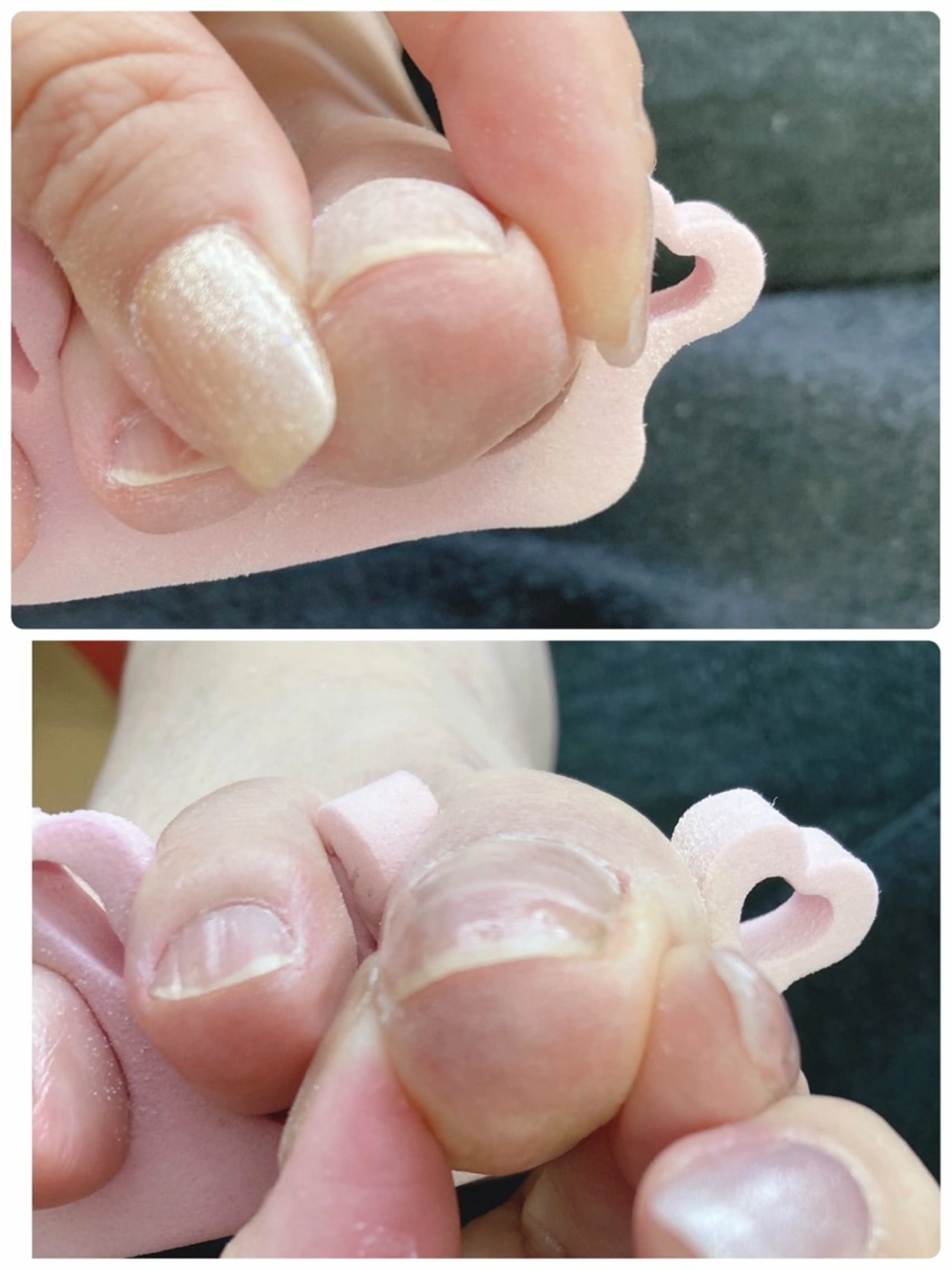 巻き爪ケアの写真