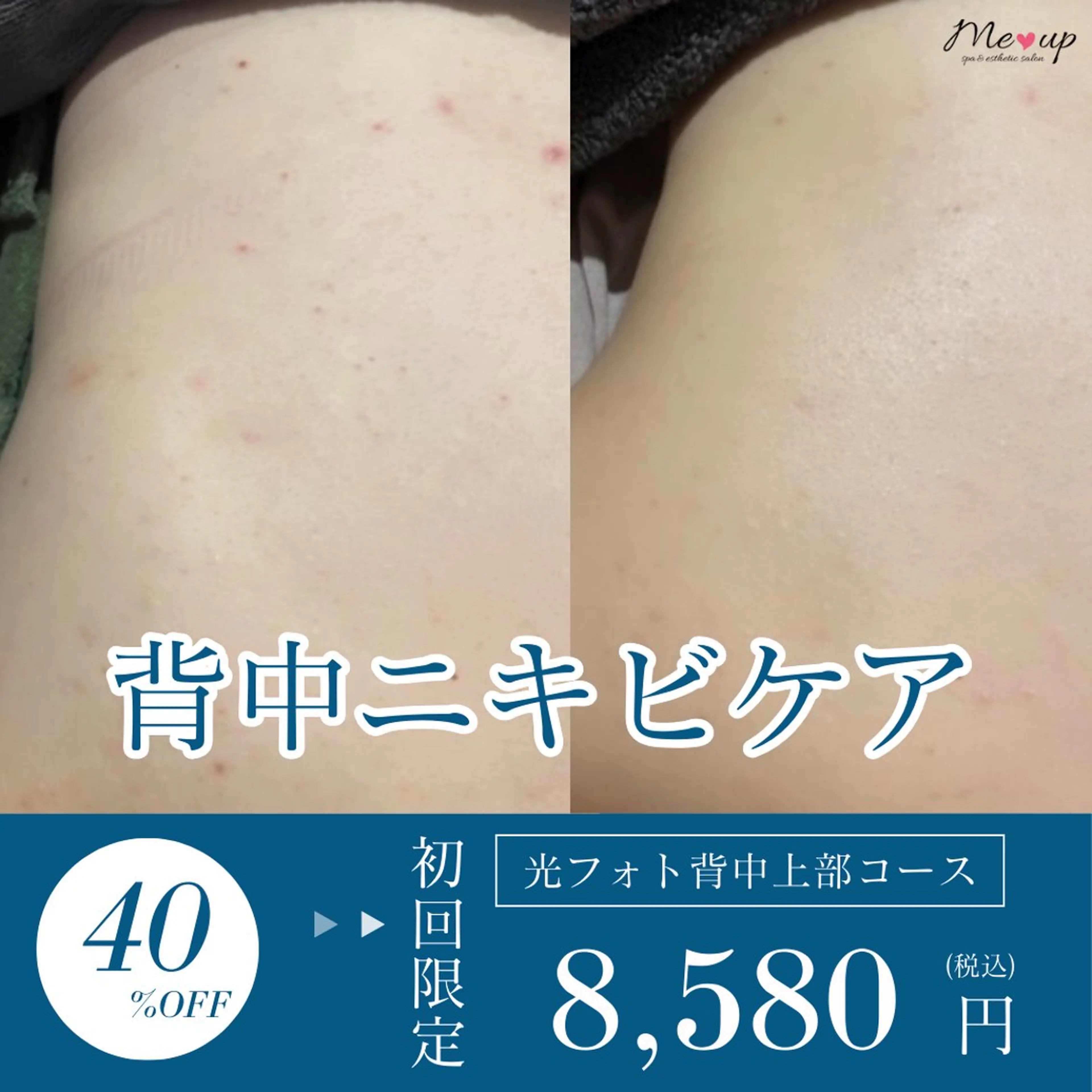 【ニキビ・ニキビ跡・シミケア】背中光照射　上部or下部のみの写真