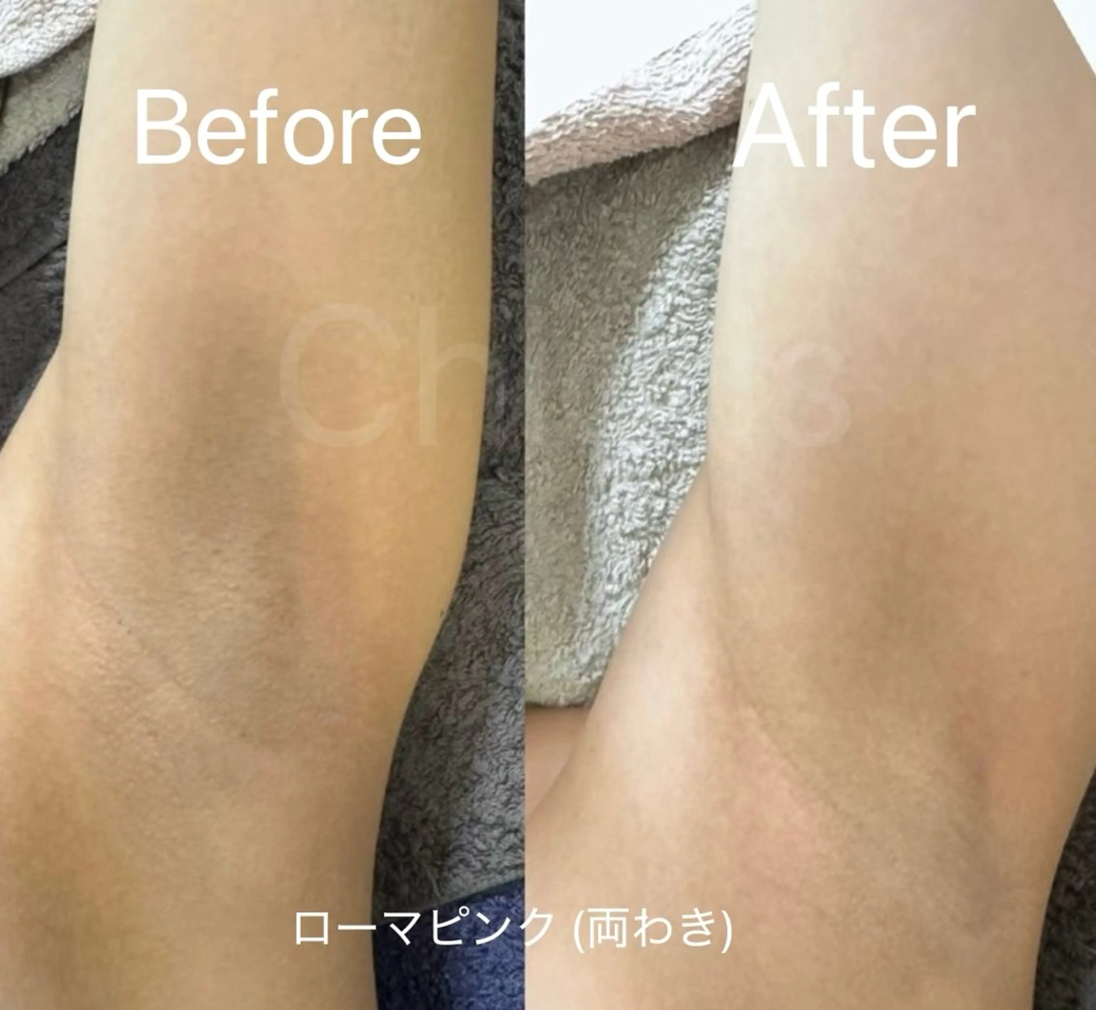 川越デリケートゾーン 光脱毛/ワックス脱毛のエステ・リラクイメージ