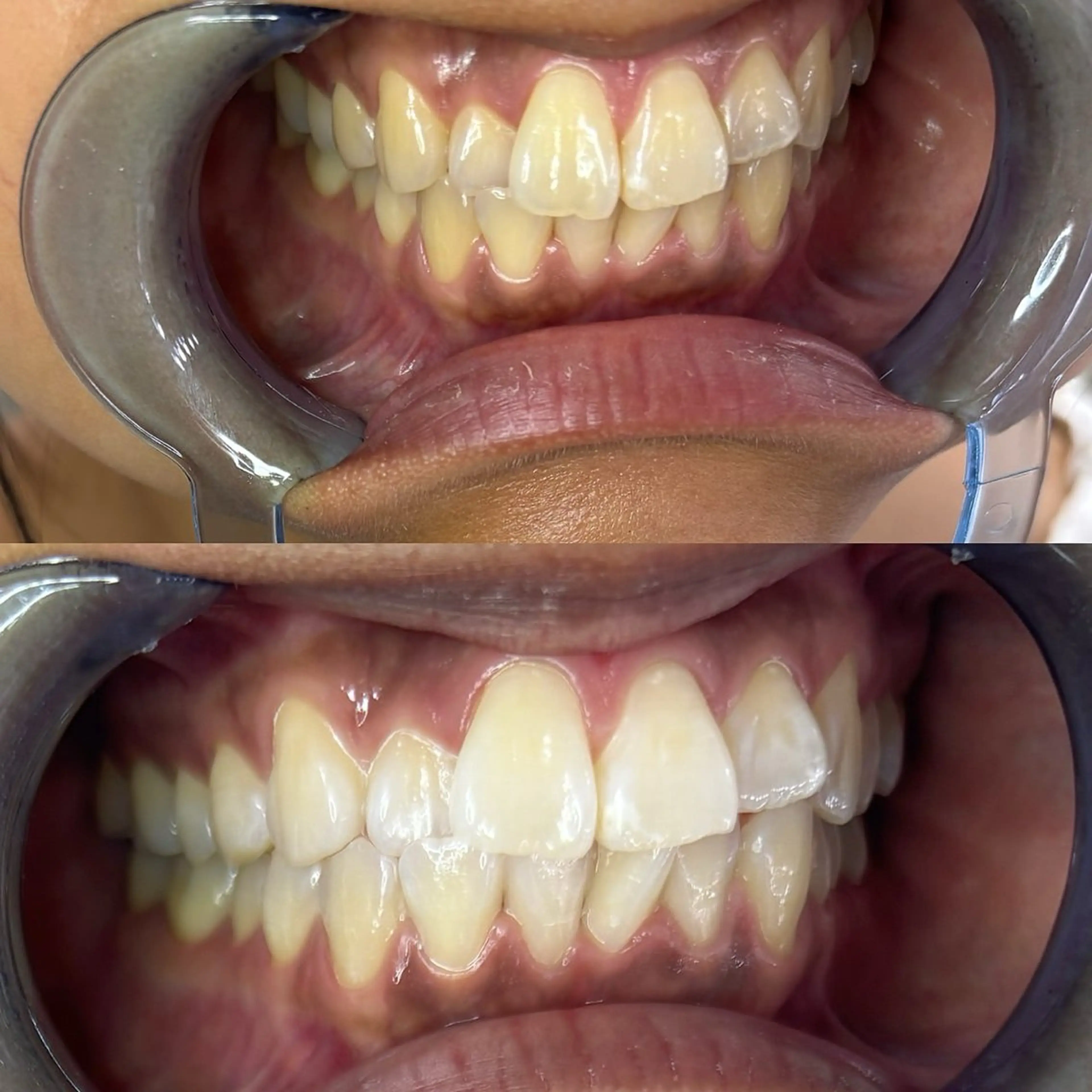 セルフホワイトニング 耳ツボジュエリーのエステ・リラクイメージ