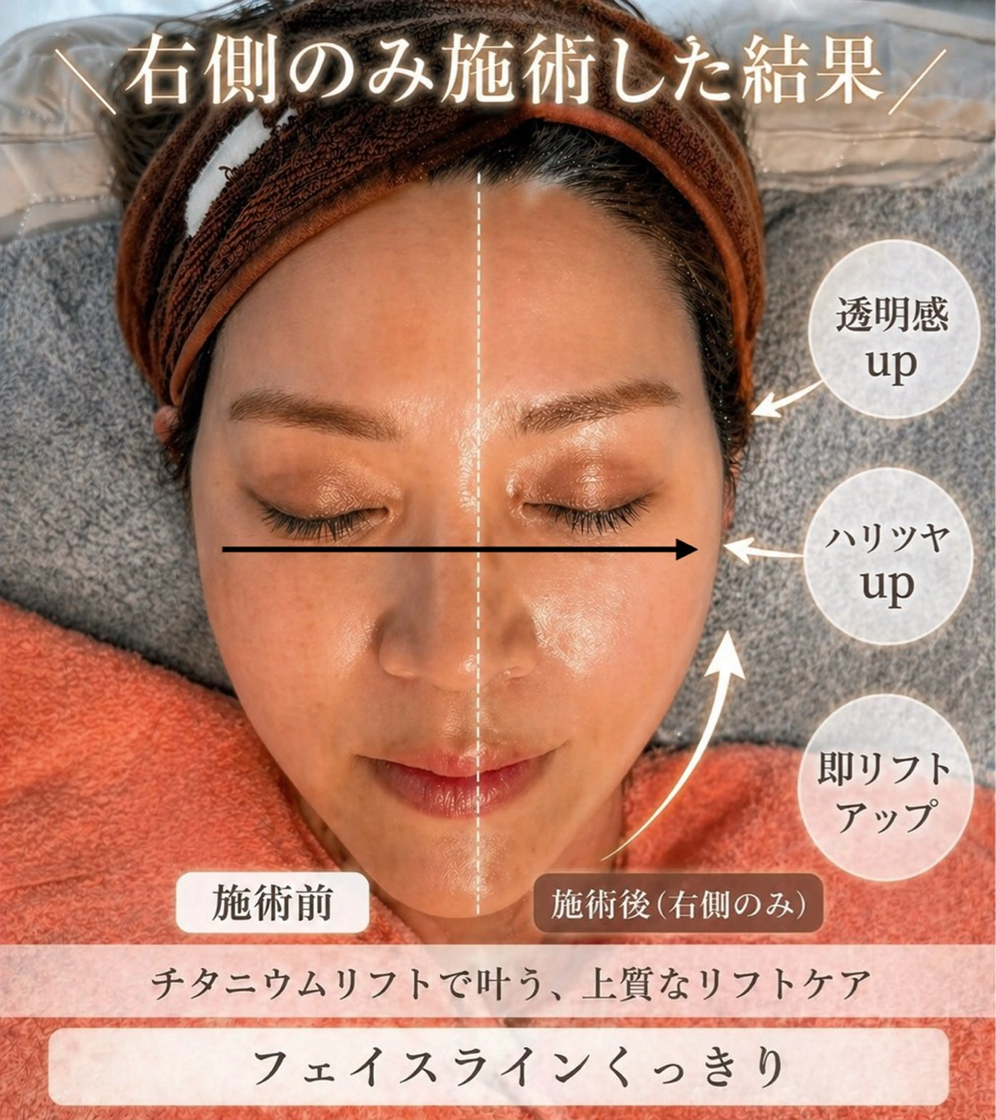 【即リフトアップ】最新マシン♪チタニウムリフト。透明感×ハリ×リフトアップ※期間限定価格の写真