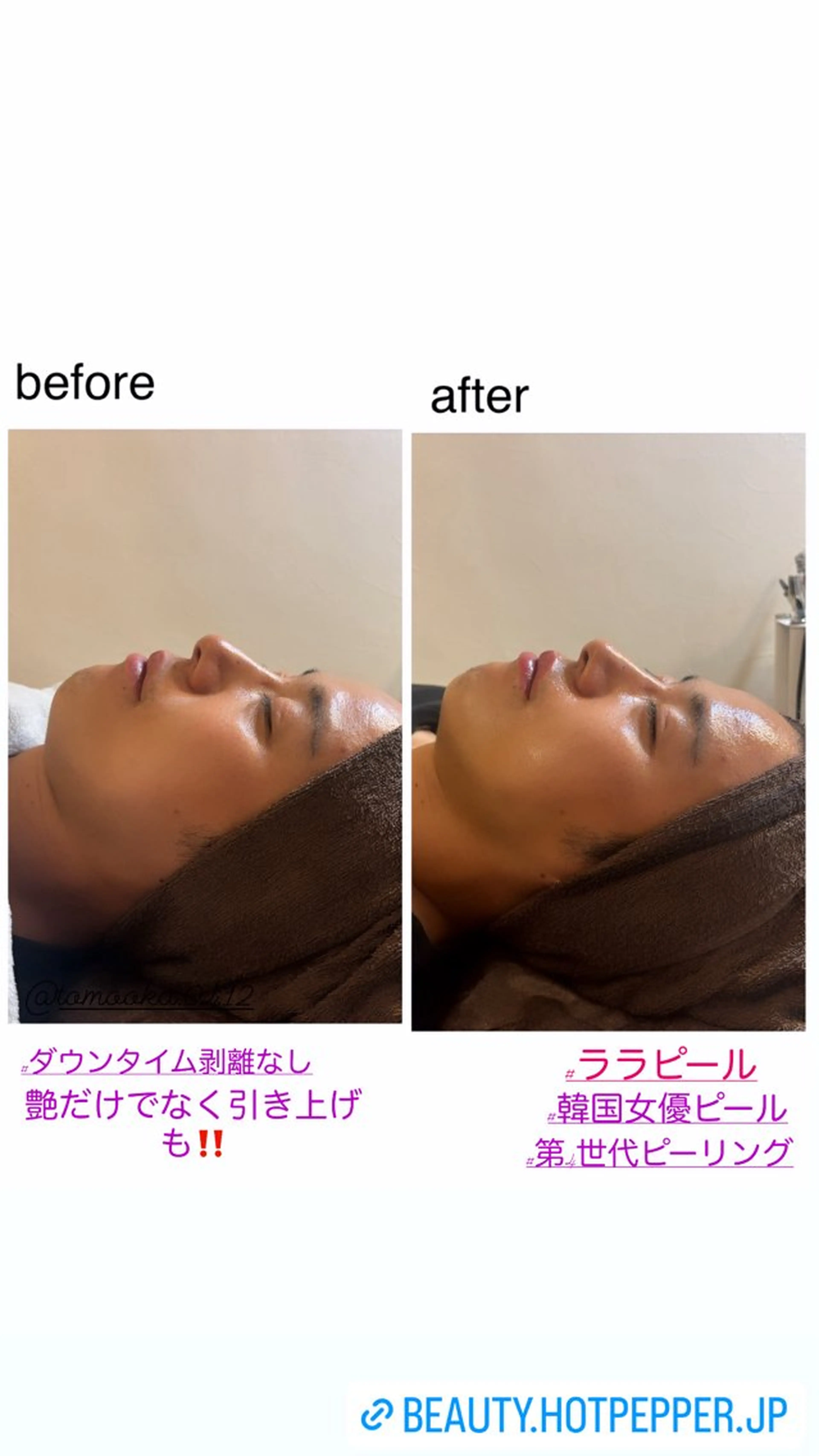 エステ ハーブピーリング専門 毛穴洗浄❤️眉waxのエステ・リラクイメージ