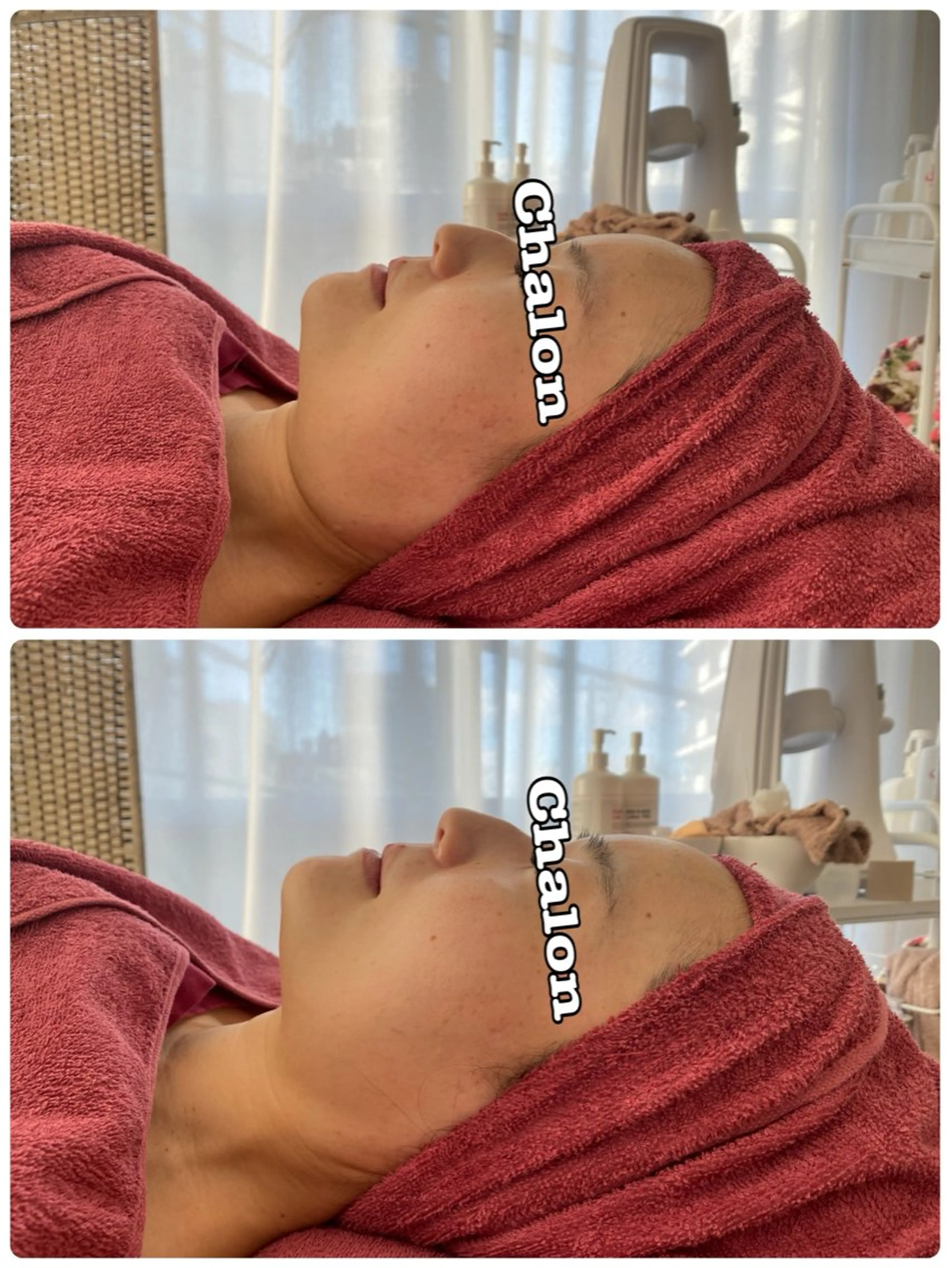 エステ Chalon所属・REVI取扱・肌悩み 毛穴Chalonのエステ・リラクイメージ