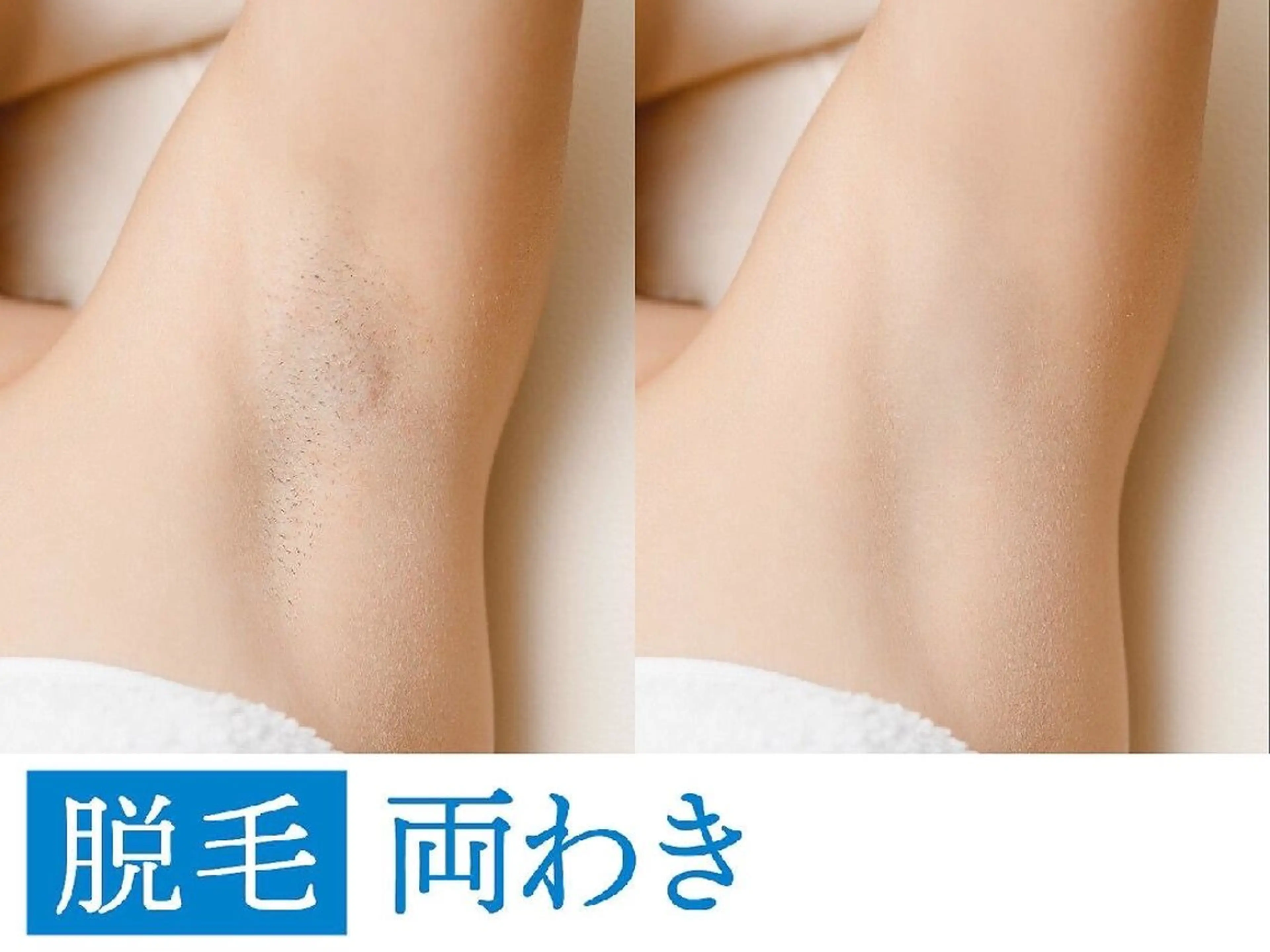 【ミニモ限定✨】両ワキ脱毛600円（通常6600円）気になる自己処理をラクに🫧 新人価格でのご案内💁‍♀️6月末までの写真