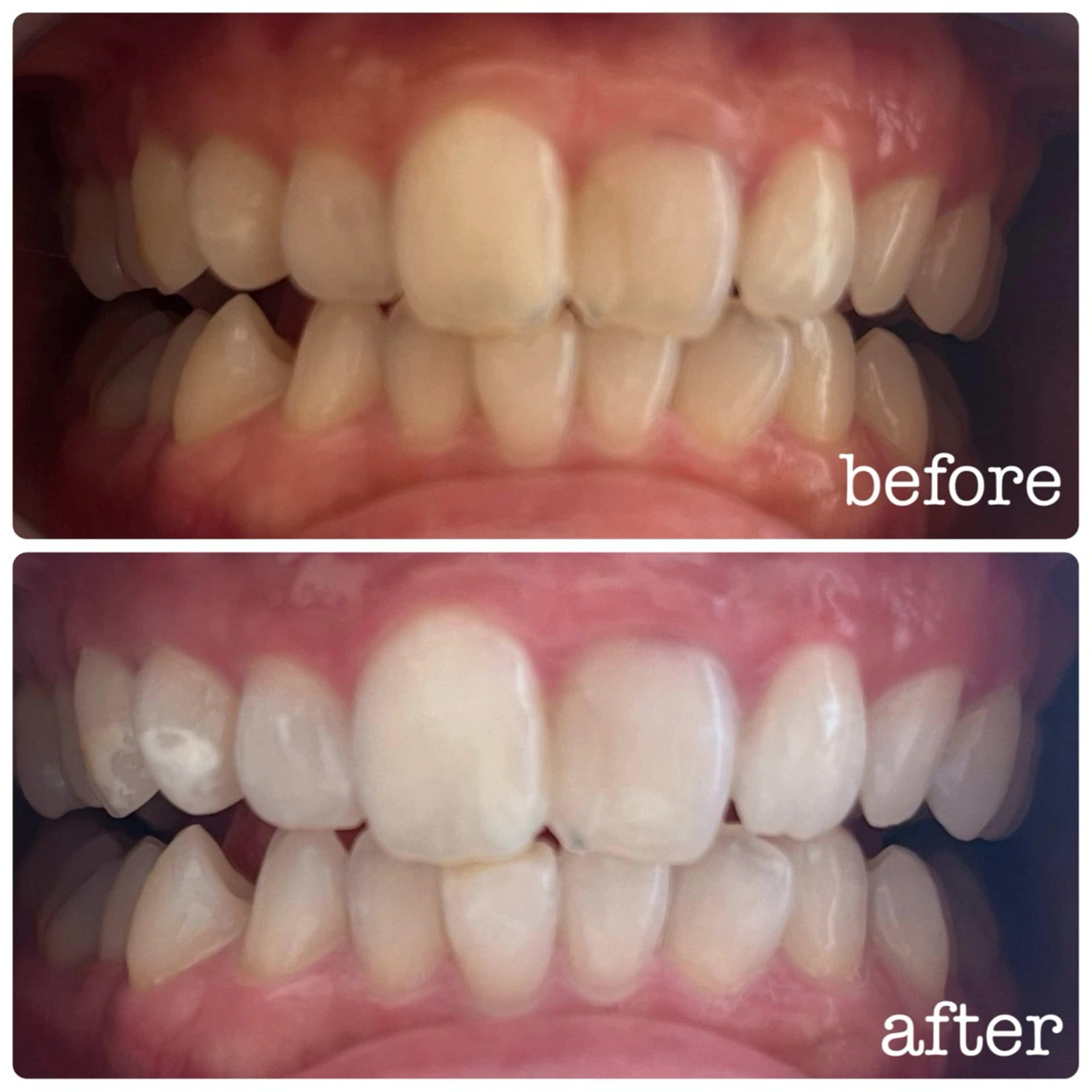 ✨ホワイトニング✨ナチュラルホワイトニング8分×5照射🦷🪥の写真