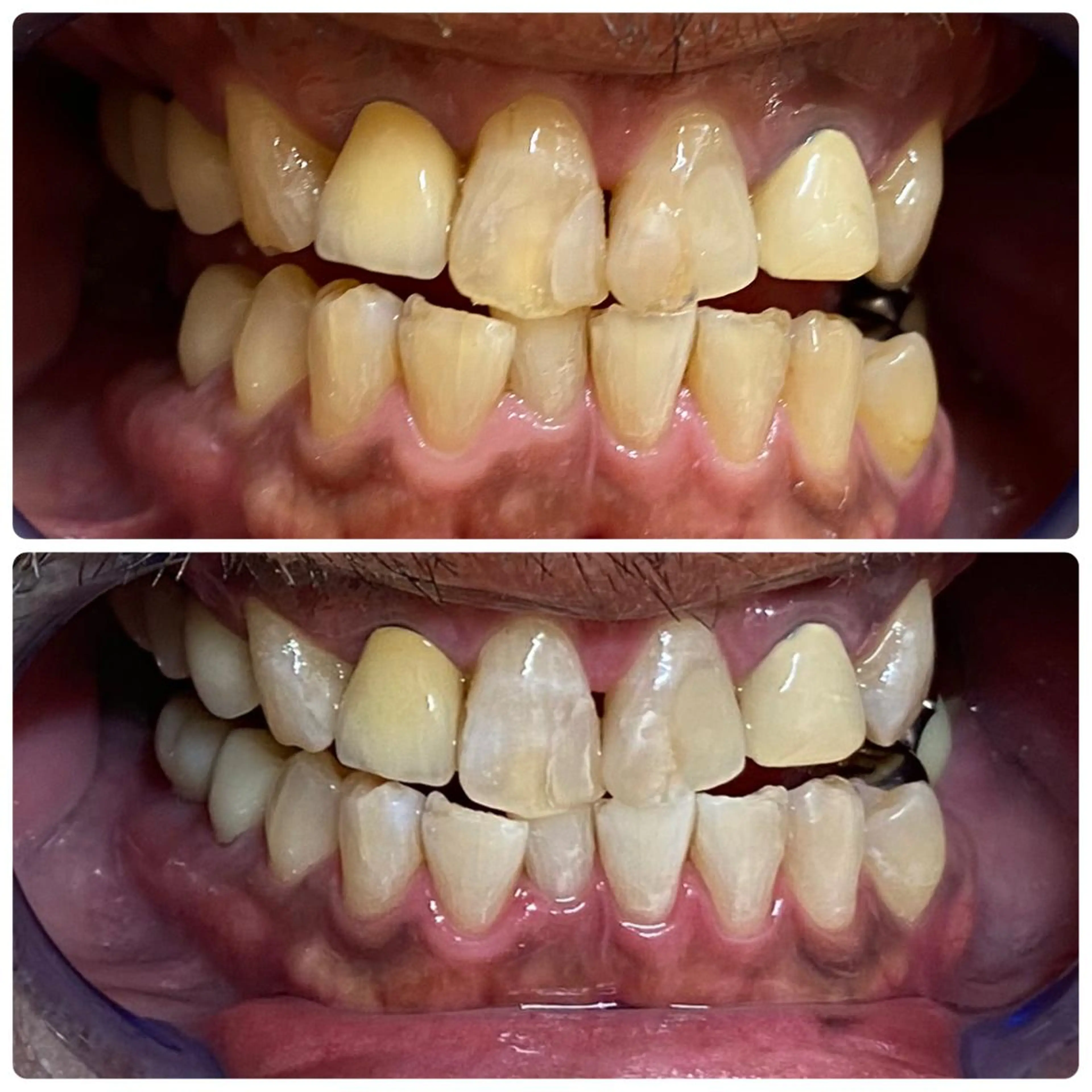 その他 セルフホワイトニング 🦷口元垢抜け✨のその他イメージ